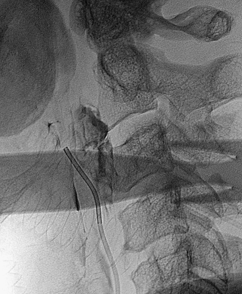 Fig. 63.7, Carotid blowout syndrome. Lateral angiogram demonstrates contrast material leaking into soft tissue surrounding diseased carotid artery.