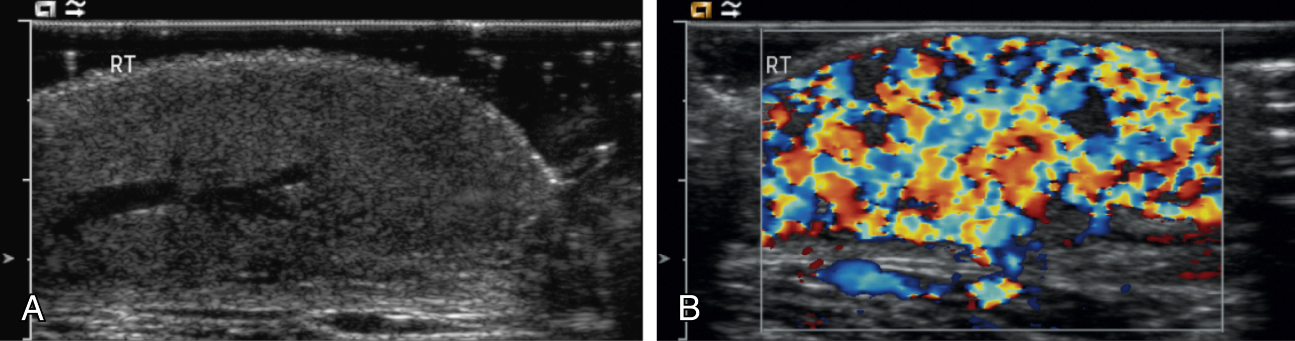 Fig. 18.1, Ultrasound images of infantile hemangioma. (A) Well-defined soft tissue mass with prominent central vessels. (B) Hypervascularity on color Doppler imaging.