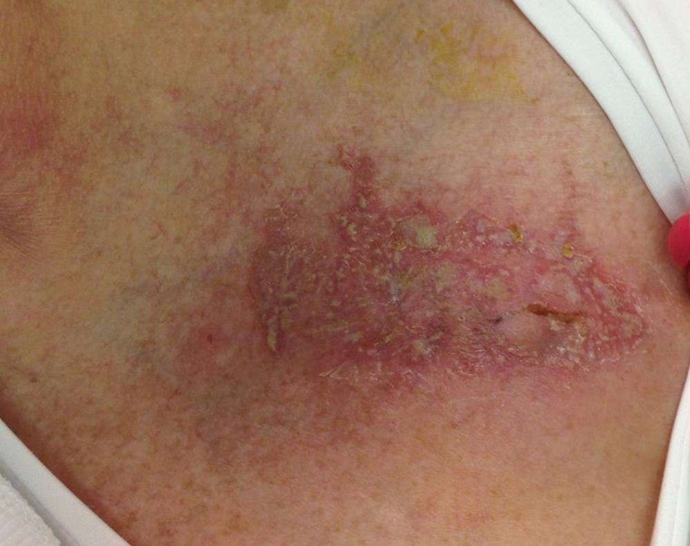 Fig. 126.3, Superficial erythematous vesicular eruption with pruritus arising 2 days after cardiac electronic device implantation consistent with allergic reaction to surgical skin adhesive (Dermabond, Ethicon Inc.).