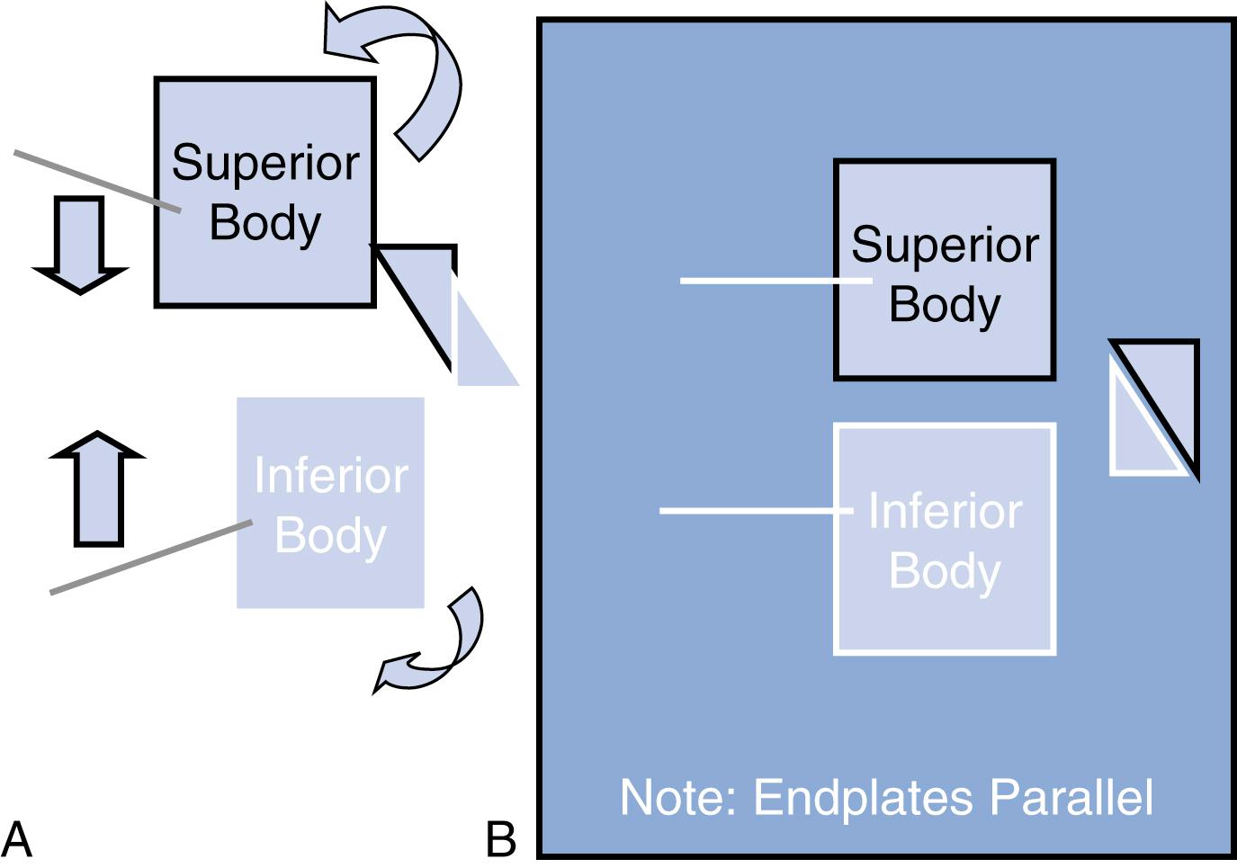 FIGURE 159.3, Reduction of “jumped” cervical facets using the technique of convergent Caspar pin placement, sagittal view. (A) demonstrates the pre-reduction alignment, and position of Caspar pin placement. (B) demonstrates reduction of subluxation and resumption of normal facet joint configuration