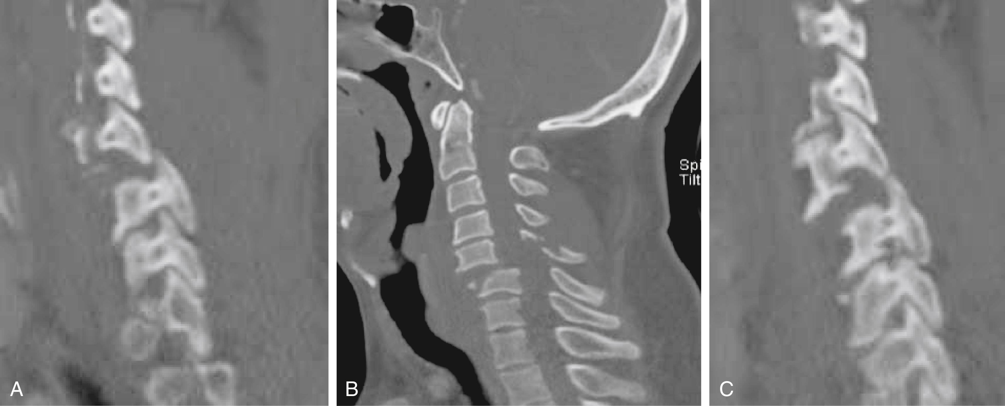 FIGURE 159.5, Noncontrasted computed tomography of the cervical spine demonstrating fracture-dislocation at C5–6 with bilateral facet dislocation. (A) Left parasagittal CT of the C spine demonstrating “jumped” left C5-6 facet. (B) Mid-sagittal CT of the C spine demonstrating anterior translation of C5 on C6. (C) Right parasagittal CT of the C spine demonstrating “perched” right C5-6 facet.