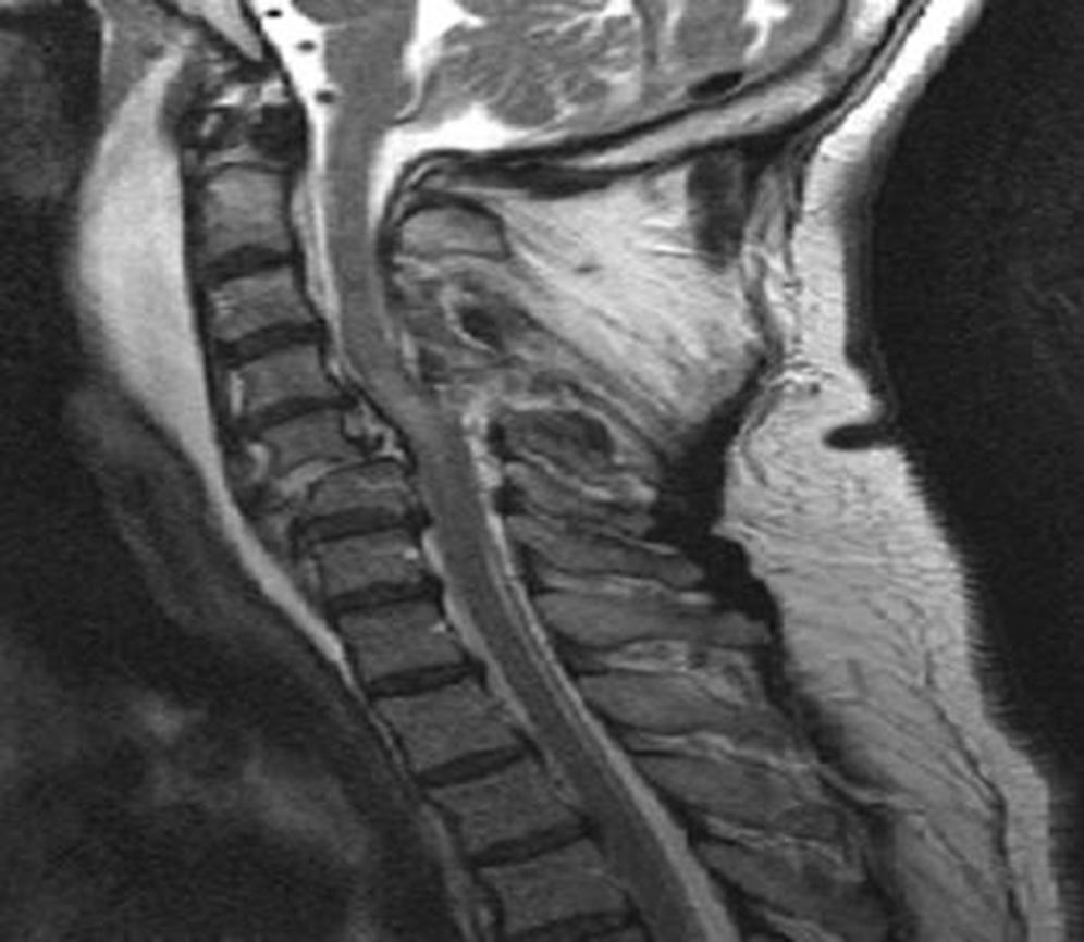 FIGURE 159.6, Sagittal T2-weighted MRI of the cervical spine demonstrating spinal cord injury related to C5–6 fracture-dislocation.