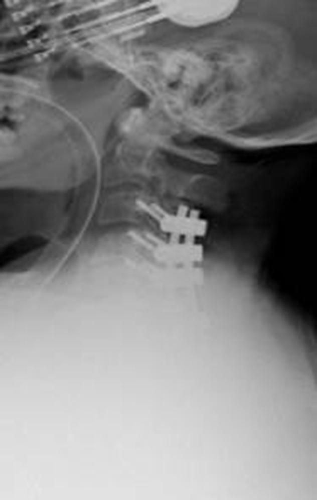 FIGURE 159.7, Postoperative lateral plain radiograph demonstrating posterior decompression and fusion.