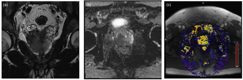 Figure 51.1, Multiparametric prostate MRI employing (a) T2-weighted sequence, (b) diffusion-weighted image, (c) dynamic contrast enhancement, demonstrating a locally advanced, predominantly right-sided malignancy.