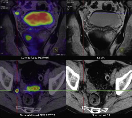 Figure 51.2, PSMA PET Scanning images fused with MRI and CT, demonstrating a bulky prostatic malignancy and solitary pelvic lymph node metastasis.