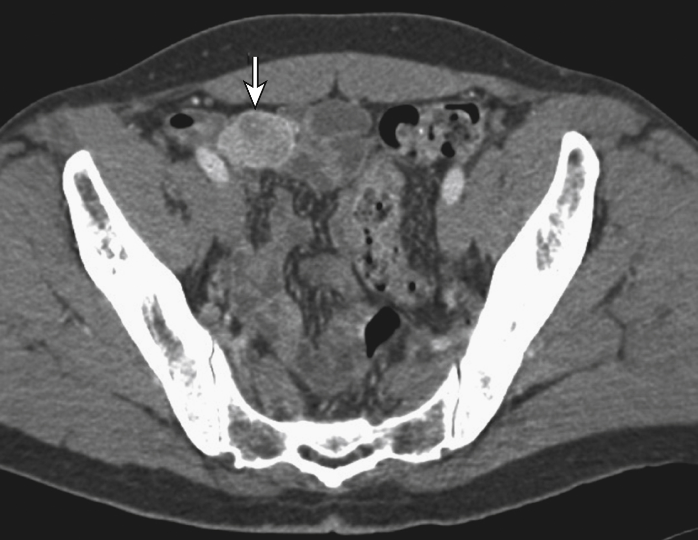 Fig. e27.1, Computed tomography done to evaluate lower gastrointestinal bleeding revealed a small-bowel tumor ( arrow ). Because the patient was stable, she was triaged to surgery rather than attempting other methods of hemostasis.