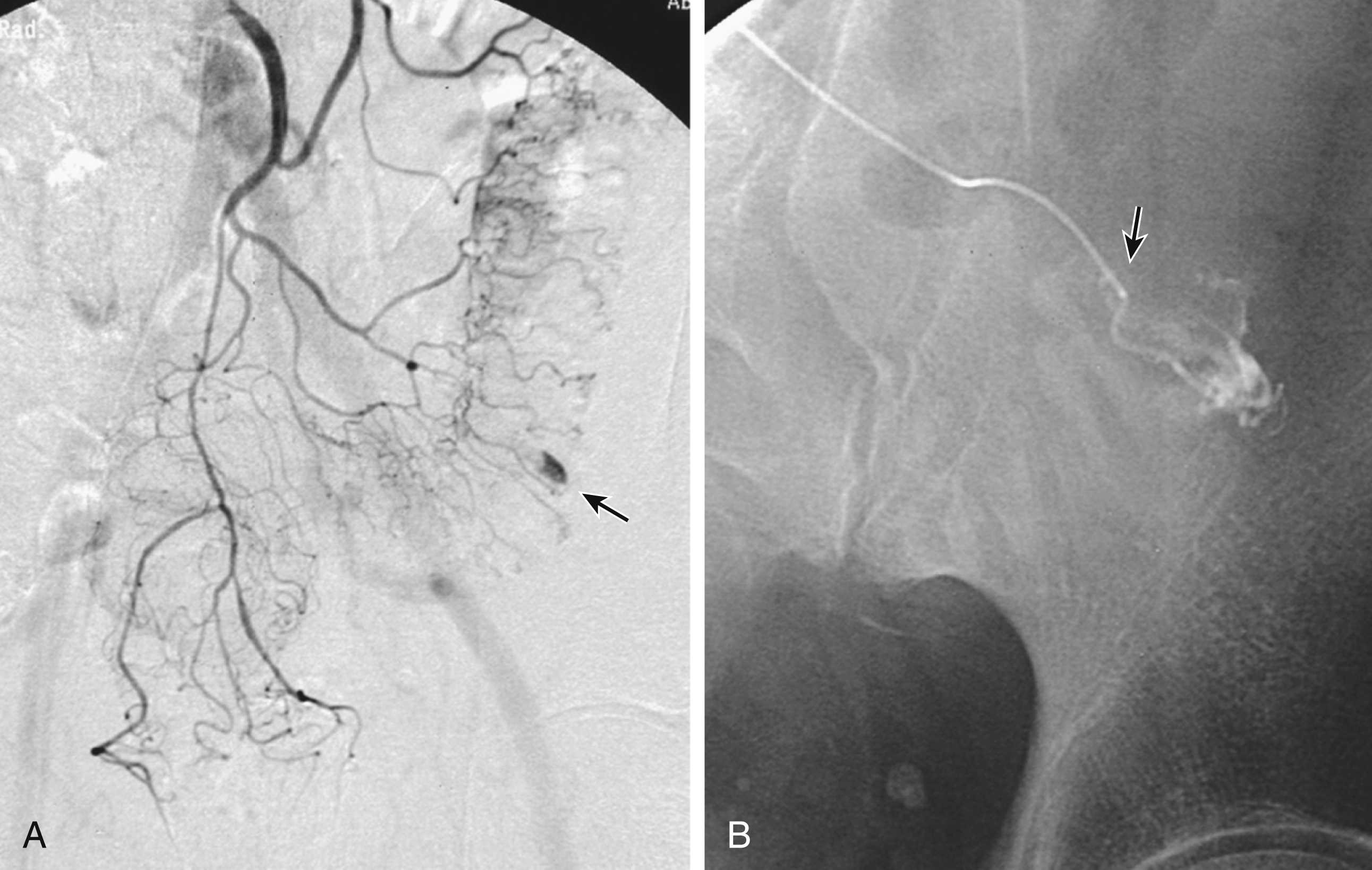 Fig. e27.2, (A) Inferior mesenteric artery (IMA) arteriogram with extravasation of contrast ( arrow ) in sigmoid colon. (B) Highly magnified view showing that microcatheter tip ( arrow ) has been advanced into vasa recta in the bowel wall and very close to site of bleeding. A single microcoil placed in this position occluded the vasa recta and terminated bleeding.