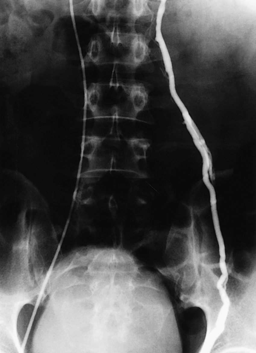 Fig. 46.1, Left gonadal venography.