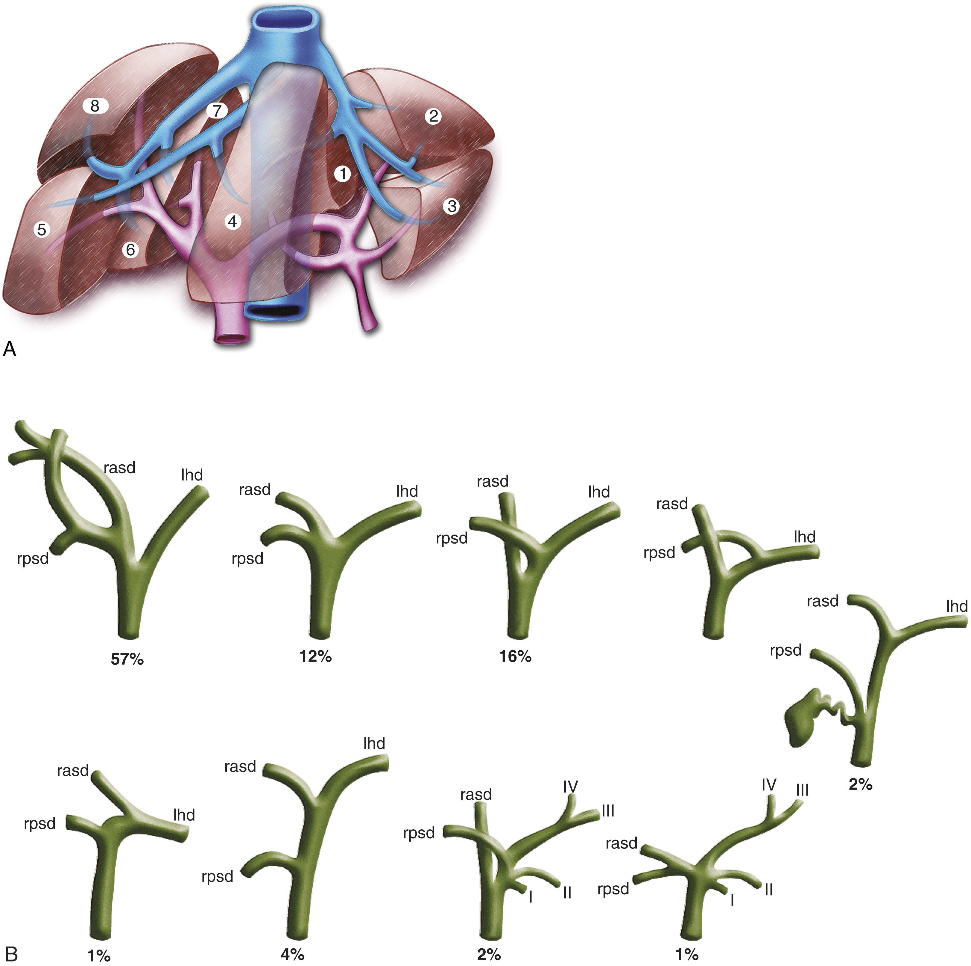 Fig. 92.1, Couinaud anatomy. (A) Segmental anatomy of the liver. Portal venous supply to each segment is shown schematically. (B) Common anatomic variants in confluence of segmental ducts at level of liver hilum. Incidence of each variant is shown. lhd , Left hepatic duct; rasd , right anterior sectoral duct; rpsd , right posterior sectoral duct.