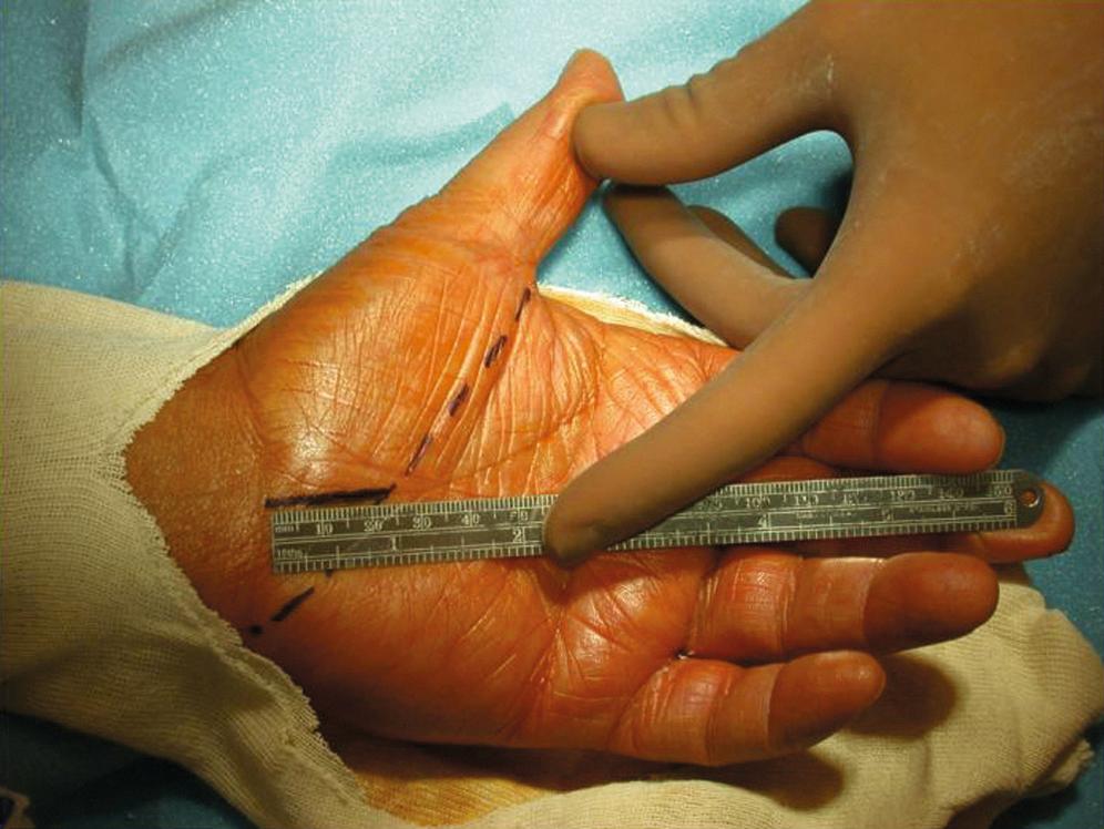 FIGURE 186.1, Intraoperative photograph demonstrating the incision for the mini–carpal tunnel release. It begins at the distal wrist crease and extends 2.5 cm distally in a linear fashion parallel with and approximately 2 mm ulnar to the midpalmar crease (or long axis of the ring finger).