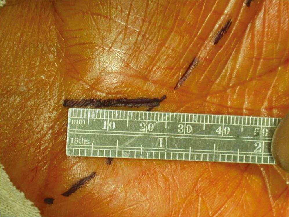 FIGURE 186.2, A close-up view of the mini–carpal tunnel release incision.