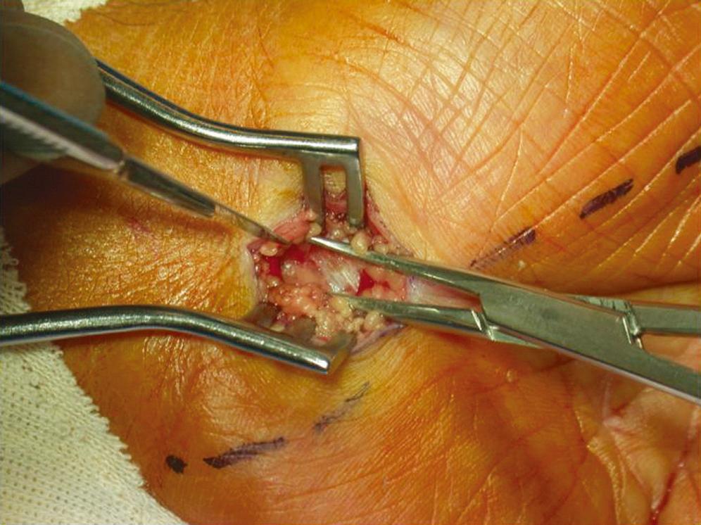 FIGURE 186.3, Intraoperative photograph showing the transverse carpal ligament following dissection through the subcutaneous fat and the palmar aponeurosis.