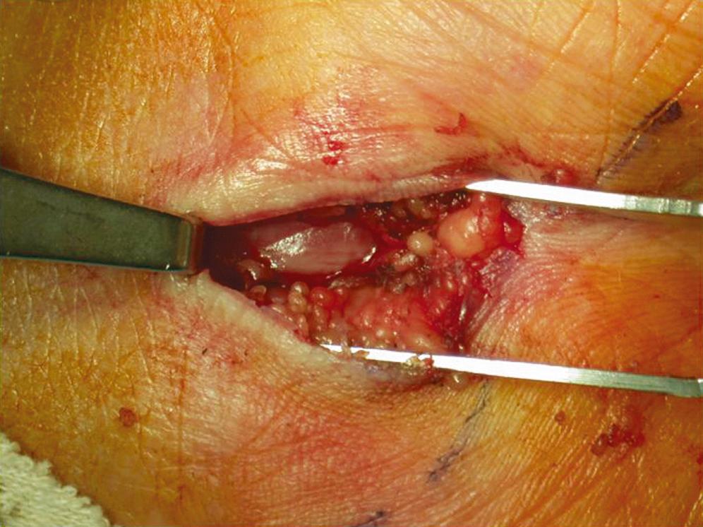 FIGURE 186.5, Intraoperative photograph demonstrating adequate proximal decompression of the median nerve following transection of the transverse carpal ligament.