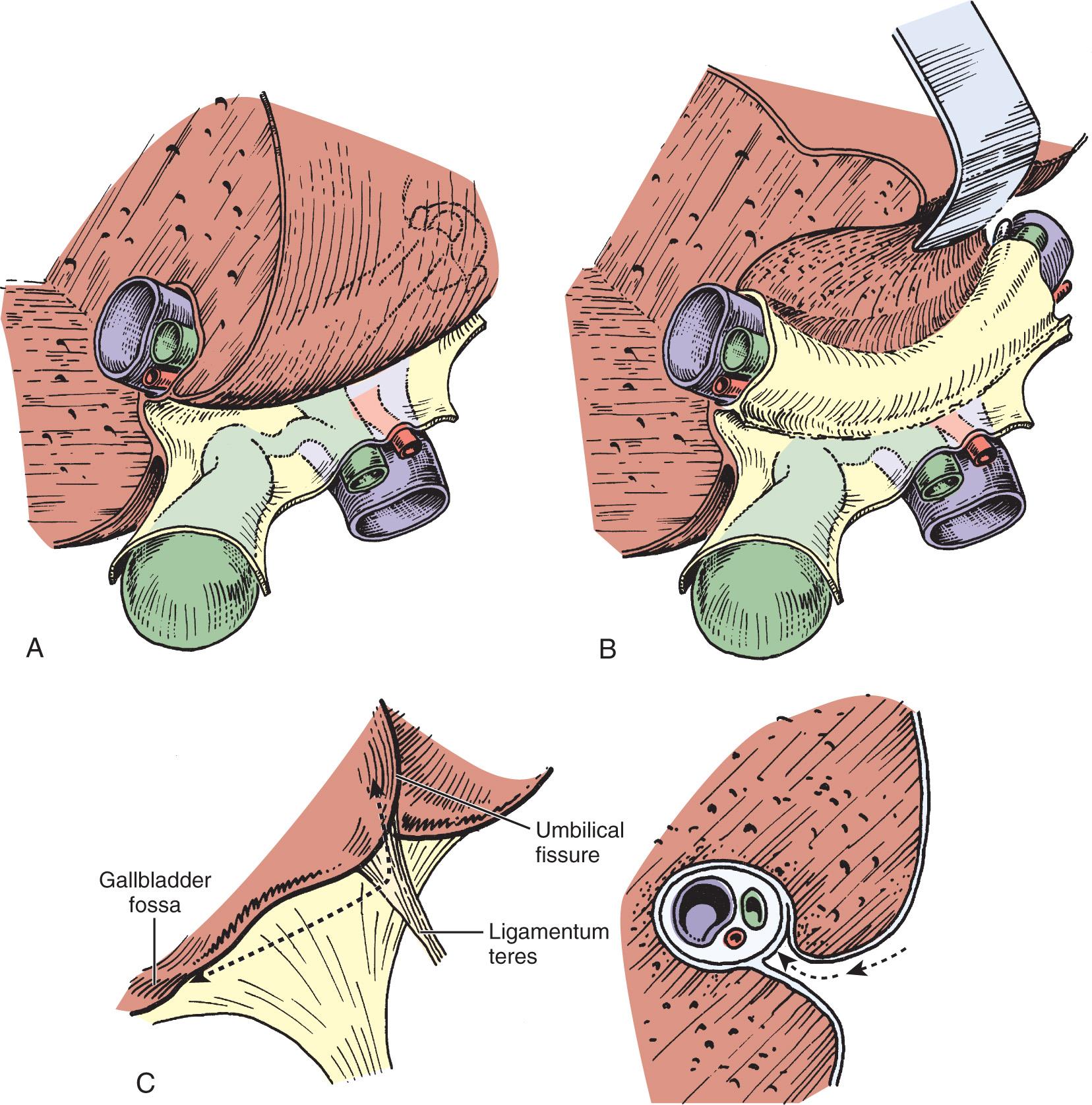 FIGURE 172.2, (A) Relationship between the posterior aspect of the quadrate lobe and the biliary confluence. The hilar plate is formed by the fusion of the connective tissue enclosing the biliary and vascular elements with Glisson capsule. (B) Biliary confluence and left hepatic duct exposed by lifting the quadrate lobe upward after incision of Glisson capsule at its base. This technique (lowering of the hilar plate) generally is used to display a dilated bile duct above an iatrogenic stricture or hilar cholangiocarcinoma. (C) Line of incision (left) to allow extensive mobilization of the quadrate lobe. This maneuver is of particular value for high bile duct stricture and in the presence of liver atrophy or hypertrophy. The procedure consists of lifting the quadrate lobe upward (see [A] and [B]), then not only opening the umbilical fissure, but also incising the deepest portion of the gallbladder fossa. Right, Incision of Glisson capsule to gain access to the biliary system (arrow).