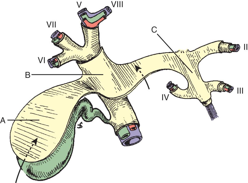 FIGURE 172.3, Sketch of the anatomy of the plate system. Note the cystic plate (A) above the gallbladder, the hilar plate (B) above the biliary confluence and at the base of the quadrate lobe, and the umbilical plate (C) above the umbilical portion of the portal vein. Arrows indicate the plane of dissection of the cystic plate during cholecystectomy and of the hilar plate during approaches to the left hepatic duct.