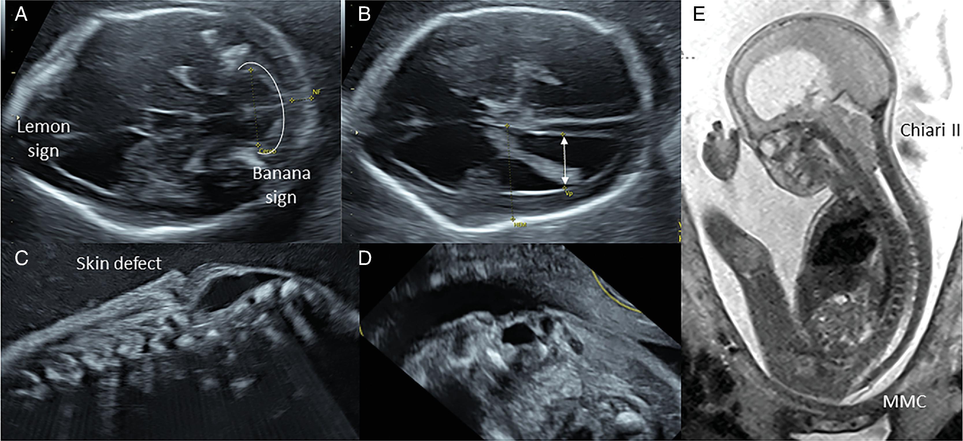 Management of Myelomeningocele and Related Disorders of the Newborn Management of Myelomeningocele and Related Disorders of the Newborn