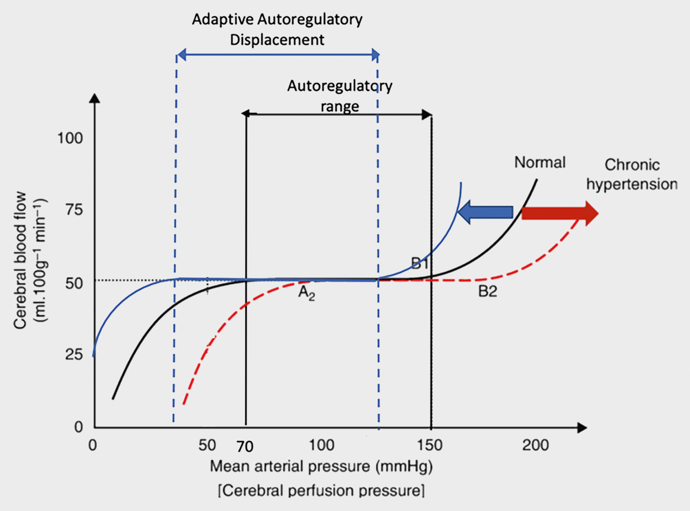 Fig. 26.1, Adaptive autoregulatory displacement. Black curve demonstrates normal cerebral autoregulation range. Red curve demonstrates rightward shift typical of patients with poorly controlled hypertension. Blue curve represents leftward shift with preserved cerebral autoregulation due to chronic arterial hypotension caused by large iAVMs.