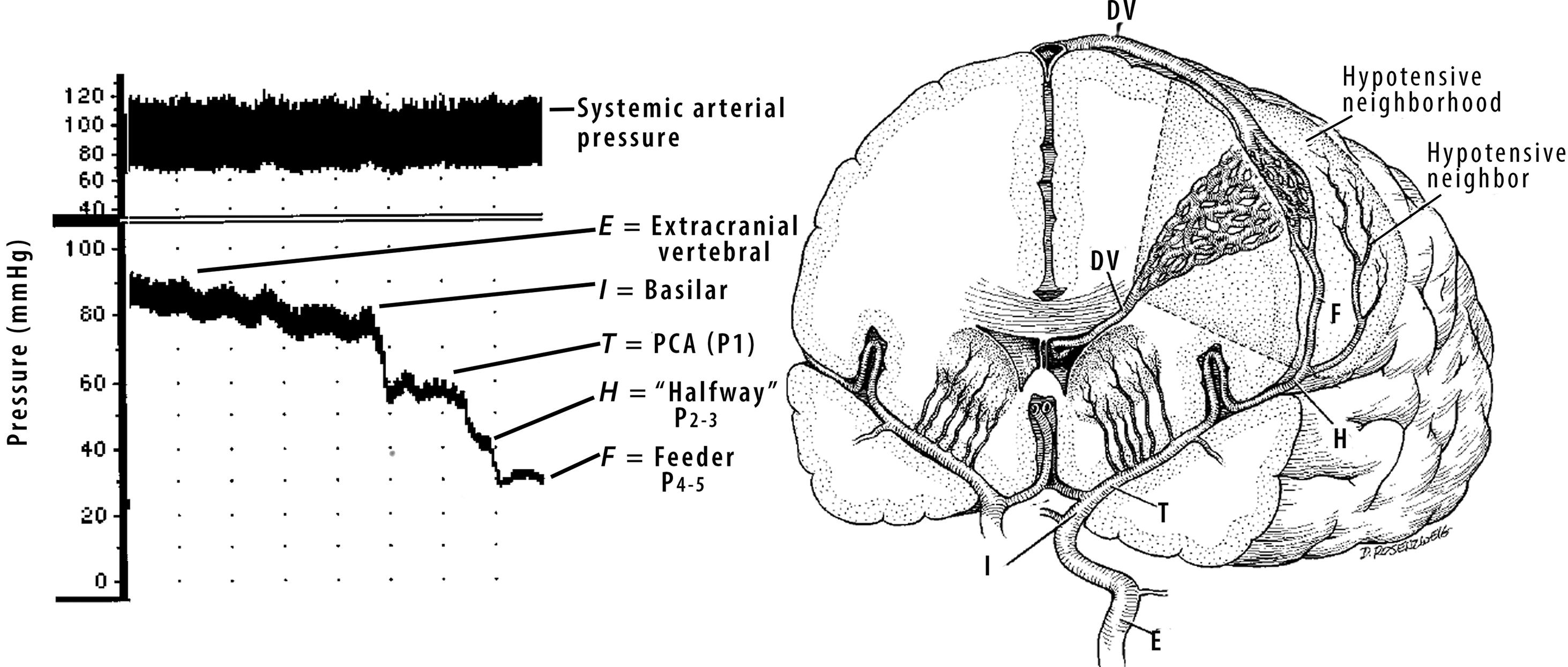 Fig. 26.2, Left , Representative pressure recording from a study of arterial pressures in patients undergoing superselective cerebral angiography before AVM embolization. 2 The recording demonstrates profound progressive pressure reduction within the vascular tree feeding the iAVM (in this case, a large temporooccipital AVM fed by branches of the middle cerebral artery and posterior cerebral artery [PCA] ). Pressure measurements were obtained in the following five zones (descriptions in parentheses are the sites used in this specific case): E , extracranial (vertebral artery); I , intracranial (basilar artery); T , transcranial Doppler insonation site (P 1 segment of PCA); H , halfway point between insonation site and feeder (P 2 –P 3 ); and F , feeding artery at the site where embolic agent was to be injected (P 4 –P 5 ). Right , Schematic depiction of intracranial circulation to an AVM showing anatomic vascular zones used for recording in the study and the functional area subject to chronic hypotension (hypotensive neighborhood). One vessel perfusing the hypotensive neighborhood, labeled the “hypotensive neighbor,” is illustrated. There is also a hypotensive neighborhood, perfused by hypotensive neighbors, in the volume of brain that has been cut away for illustrative purposes. DV , Draining vein.