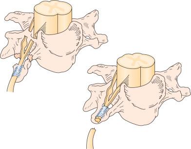 Figure 61.3, Pre- and postganglionic nerve injury.