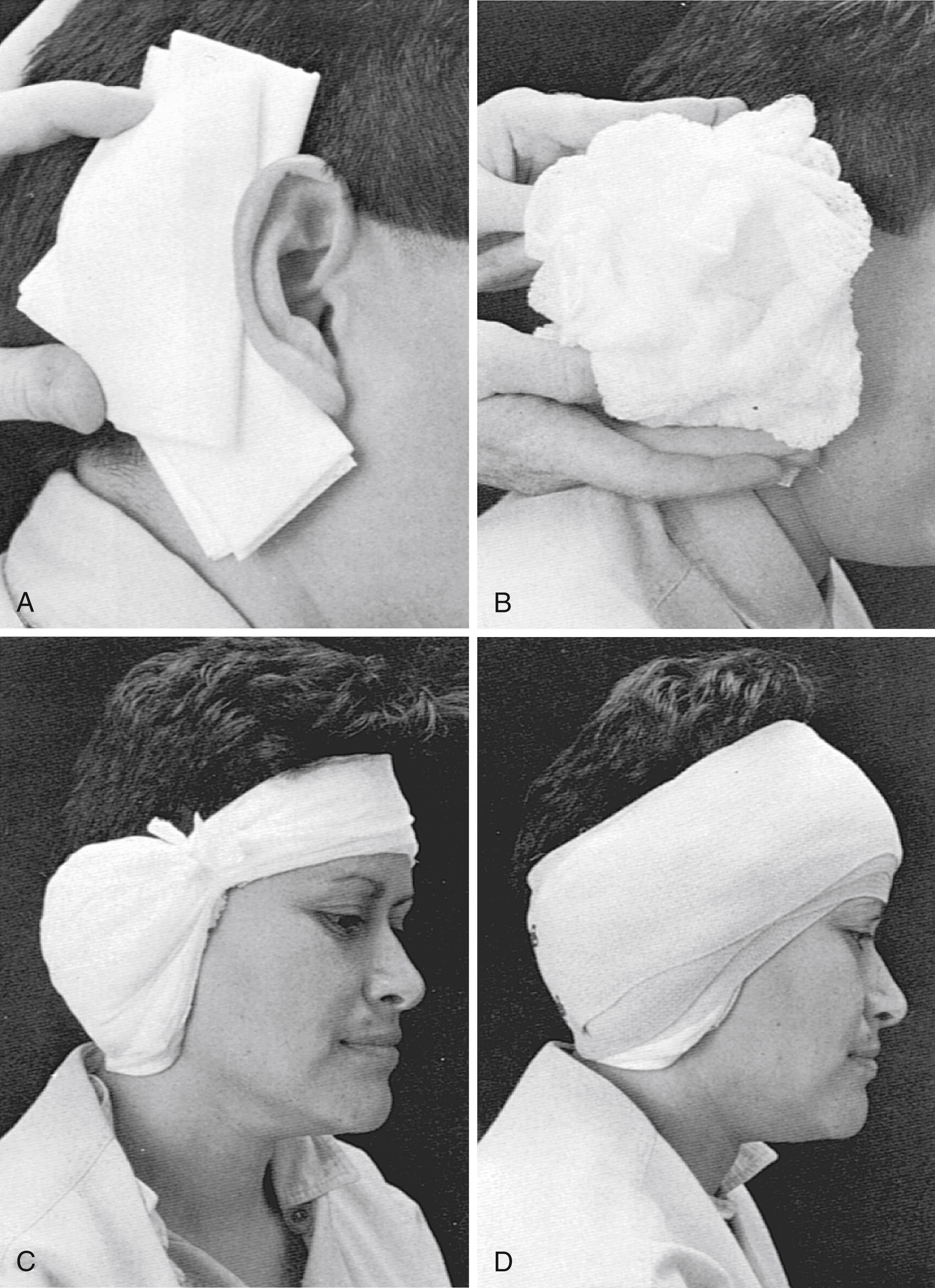 Fig. 55.1, (A) Folded 4×4 dressing sponges placed over a fat graft site after translabyrinthine acoustic tumor removal. The sponges are also placed in the postauricular crease to support the auricle. (B) Fluffed Kerlix in place over 4×4 sponges. (C) Appearance of dressing after roller gauze wrap. Tape can be applied to secure the position of the dressing; this is especially helpful on the forehead, where the dressing may slide inferiorly onto the brow. Note the laterally placed vertical gathering tie. (D) Ace wrap in place. Tape can be helpful to stabilize the elastic dressing.