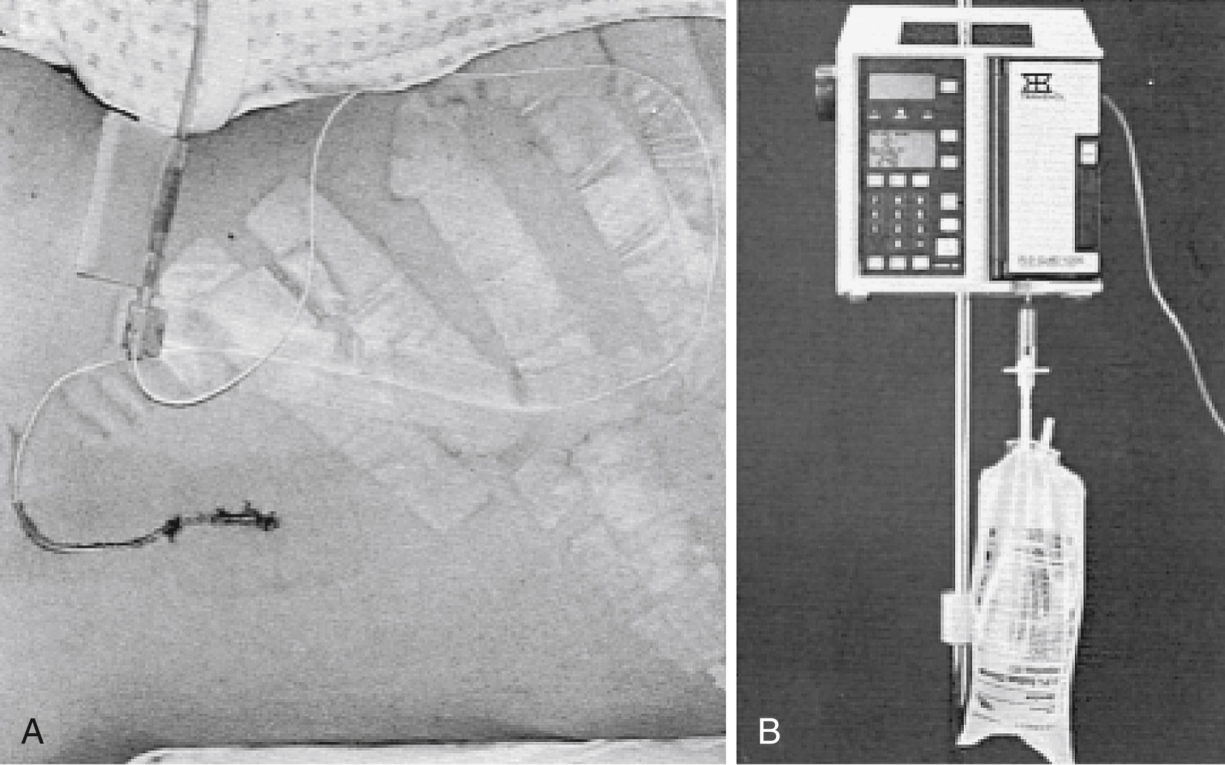 Fig. 55.3, (A) Site of lumbar puncture at L4–L5, with epidural catheter secured in place by Tegaderm. This provides an occlusive seal over the catheter site and allows for easy inspection of the site. (B) An infusion pump is set up to withdraw cerebrospinal fluid from the patient and into the collection bag.