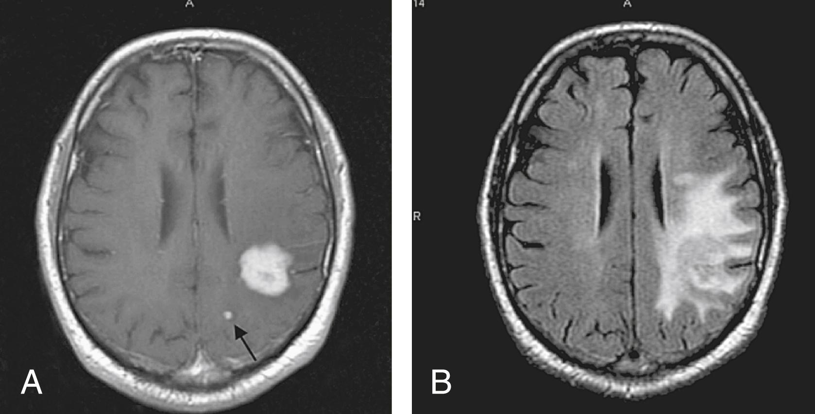 FIGURE 9.2, T1-enhanced (A) and FLAIR (B) MRI showing the infiltrative character of primary central nervous system lymphoma (PCNSL). Arrow shows small satellite area of enhancement that on the FLAIR seems to be connected to the larger lesion.