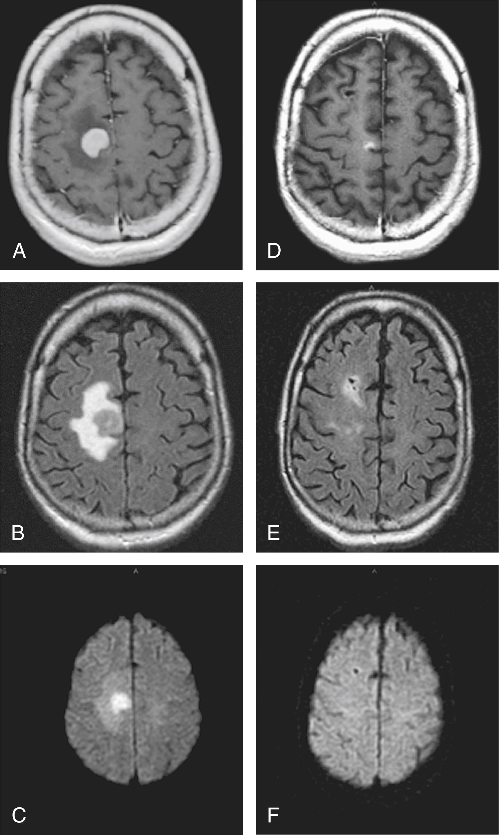 FIGURE 9.3, T1-enhanced (A), FLAIR (B), and DWI (C) magnetic resonance imaging of patient with primary central nervous system lymphoma at the time of diagnosis (A, B, and C) and after five cycles of chemotherapy (D, E, and F).