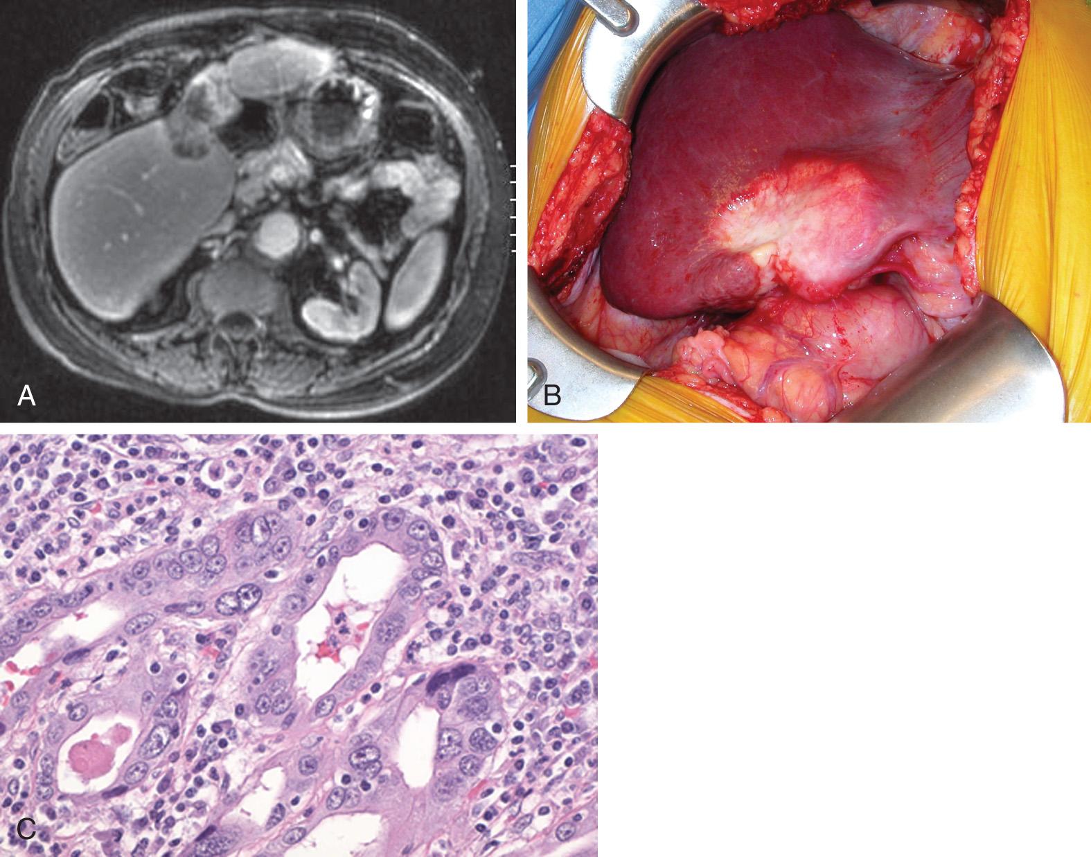 FIGURE 133.1, (A) Magnetic resonance imaging demonstrating a 6-cm intrahepatic cholangiocarcinoma involving the left hemiliver. (B) Intraoperative photograph demonstrating the same tumor prior to planned resection. (C) Photomicrograph of an intrahepatic cholangiocarcinoma. The small glandular structures with nuclei are oval and vesicular. There is also demonstrable mucin production within the ducts.