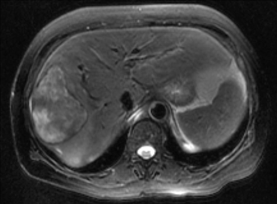 FIGURE 133.2, Abdominal magnetic resonance imaging revealing a large right liver mass. Pathologic analysis following resection demonstrated findings consistent with a mixed cholangiohepatocellular carcinoma.