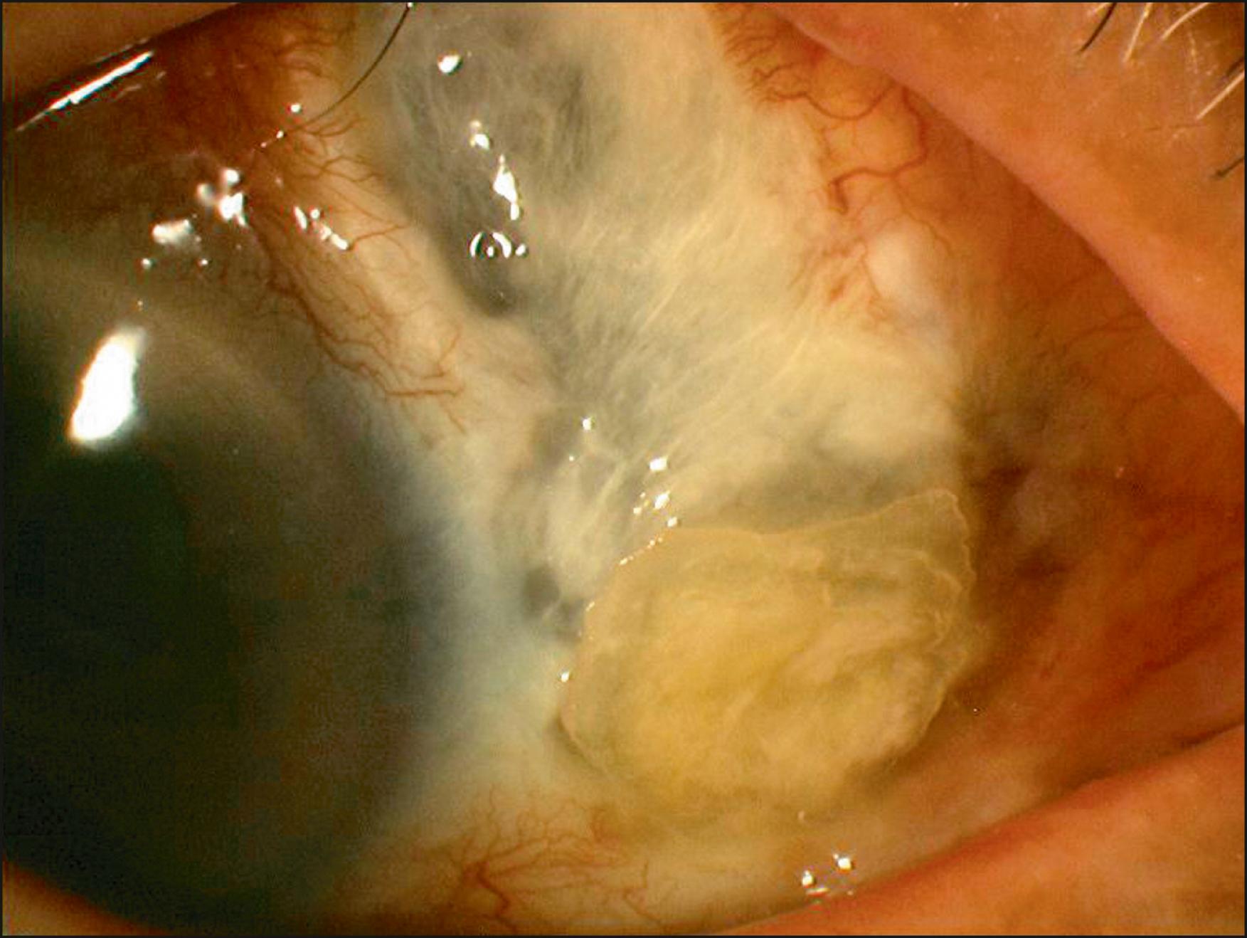 Fig. 144.2, Scleral necrosis after pterygium excision.