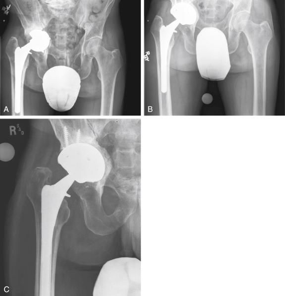 FIGURE 56.2, A, The anteroposterior radiograph of a 51-year-old man shows failure of the acetabular component and protrusio. B, Intraoperatively, a large medial defect was noticed, but there was sufficient anterior and posterior column for placement of the acetabular component with screw fixation. C, One year postoperatively, the medial bone graft has incorporated and remodeled.