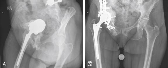 FIGURE 55.1, A, A 54-year-old patient underwent repeat surgery immediately after a failed attempt at implantation of a bilobed acetabular component. B, The patient had a pelvic discontinuity in addition to the medial wall defect.
