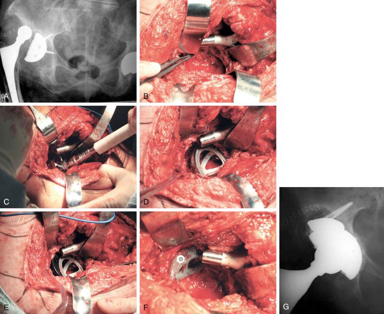 FIGURE 55.2, A, Anteroposterior radiograph of a 90-year-old woman with a failed acetabular component and substantial bone loss. B, Intraoperative photograph of the defect. C, Reaming of the acetabulum. D and E, Trialing with the acetabular component and an augment. F, The augment before placement of the acetabular component. G, Postoperative anteroposterior radiograph.