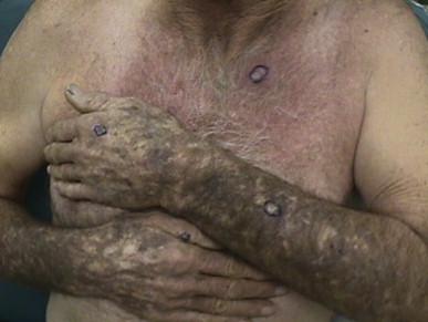 Figure 58.1, Cardiac transplant patient with a history of multiple squamous cell carcinomas on the chest and extremities. Note the numerous hyperkeratotic papules on the arms. Actinic keratoses, verrucae and squamous cell carcinomas are present.