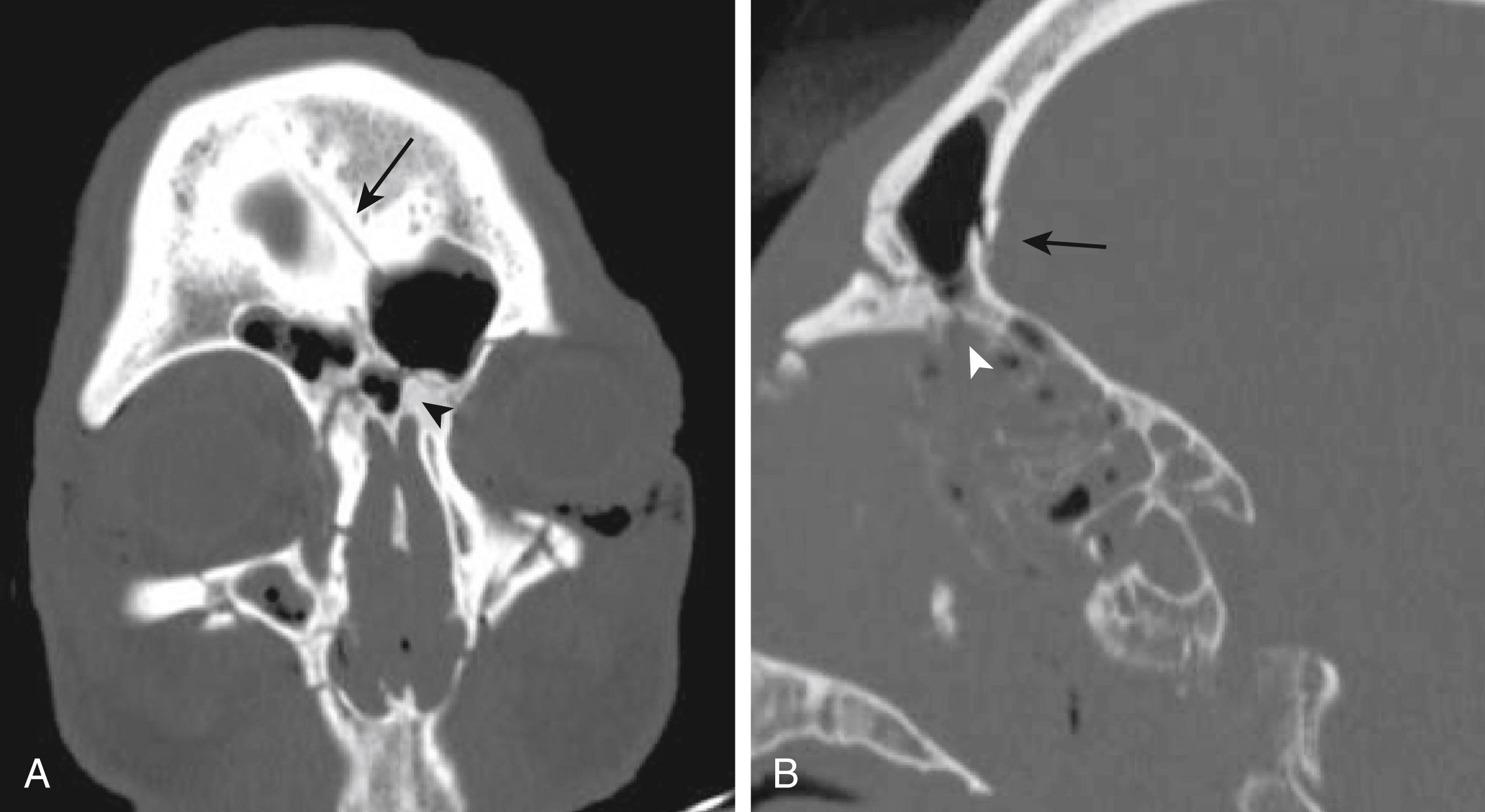 FIGURE 124.1, Traumatic anterior skull base cerebrospinal fluid (CSF) leak. Computed tomography bone window imaging of a 59-year-old male with schizophrenia following a jump from 40 feet. (A) A coronal view demonstrates a frontal bone fracture (black arrow) extending to the nasal bone (black arrowhead) . (B) A sagittal image shows a fracture of the posterior wall of the frontal sinus (black arrow) and the nasoethmoidal extension of the fracture (white arrowhead) . The patient’s CSF leak was refractory to lumbar drain diversion and worsened with an attempted endoscopic extracranial approach to reduce and plate the nasal fractures. The leak resolved following a bicoronal exploration of the fistula, wherein the olfactory nerves were observed to be intact and a generous vascularized pericranial graft was placed extradurally at the base of the posterior frontal sinus.