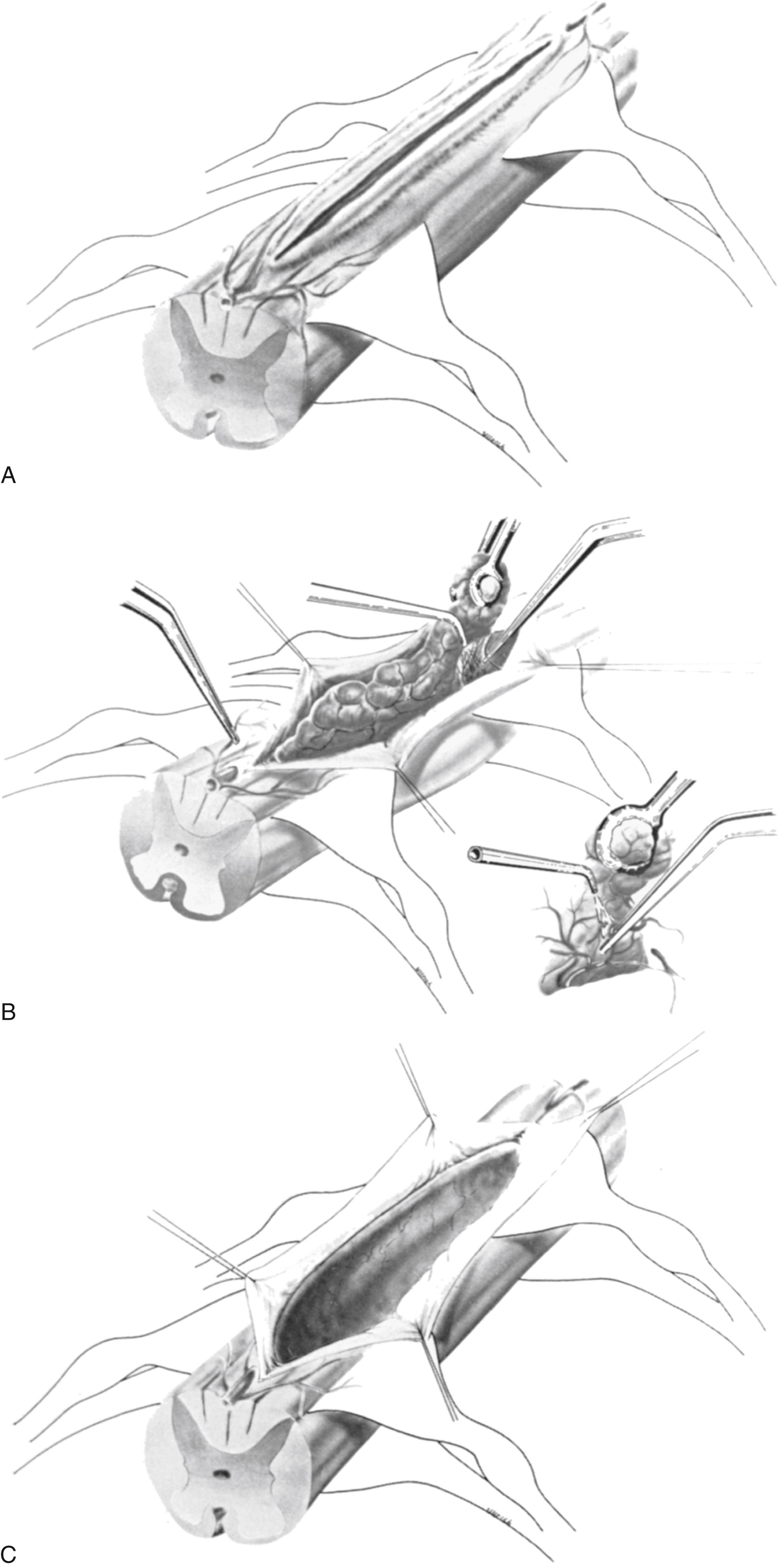 FIGURE 175.1, (A) Myelotomy over an intramedullary tumor. (B) Removal of an intramedullary tumor. (C) The open cord after removal of an intramedullary tumor.