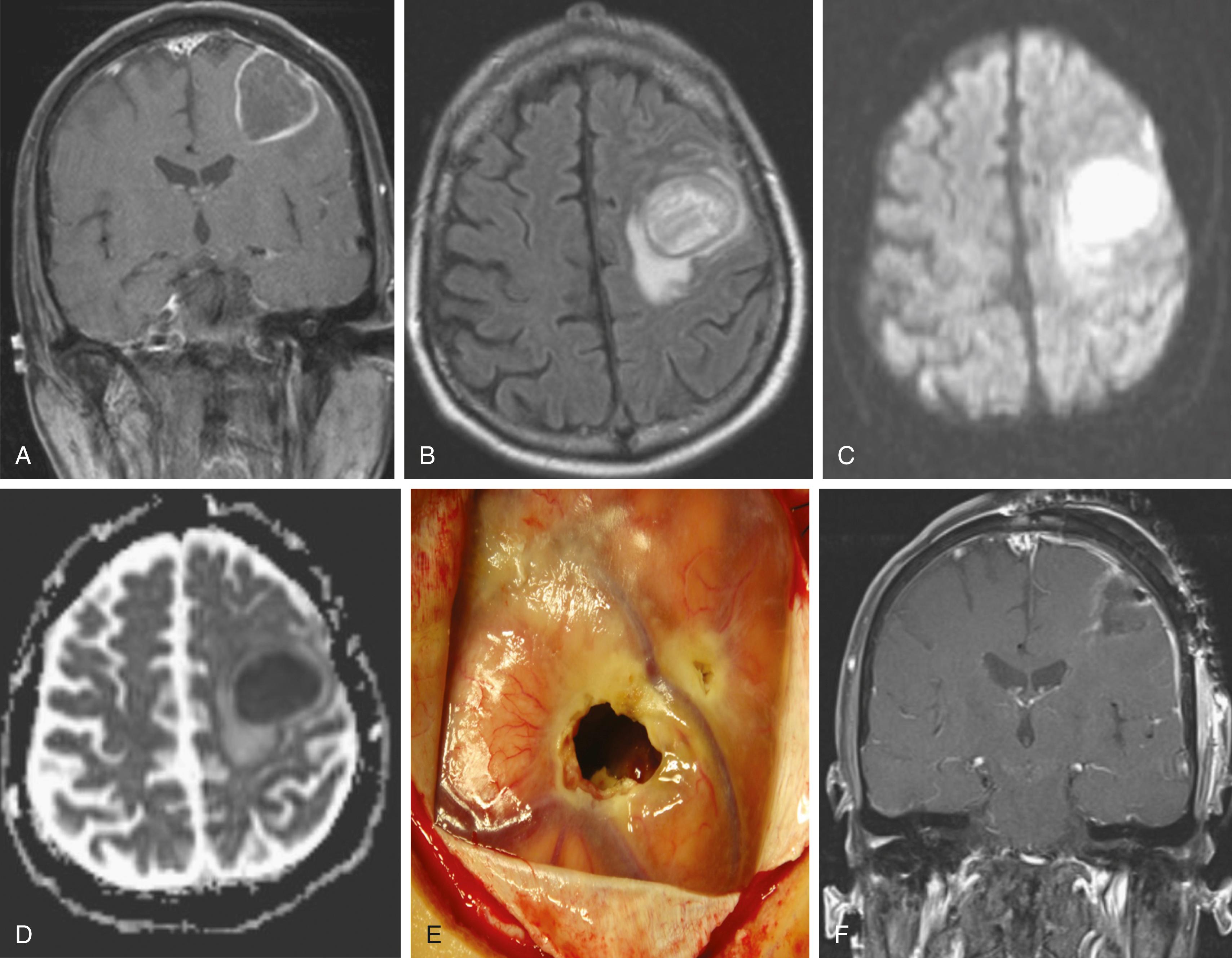 FIGURE 128.1, This 50-year-old man with history of dental disease and excessive alcohol use initially presented with seizures of the right arm and leg, as well as expressive aphasia. (A) A preoperative MRI coronal T1-weighted image with contrast revealed a ring-enhancing lesion on the area of the left frontal lobe. (B) An axial fluid-attenuated inversion recovery (FLAIR) image revealed mass effect and edema. A diffusion-weighted signal (C) and apparent diffusion coefficient (ADC) (D) showed restricted diffusion within the entirety of the lesion. The patient was taken to the operating room. (E) A craniotomy with frameless surgical navigation was conducted, with preservation of the cortical veins draining to the superior sagittal sinus, which revealed a pocket of purulent material. The cultures revealed Fusobacterium brain abscess sensitive to penicillin. Workup for a source of brain abscess included a transesophageal echocardiogram, which showed 7 mm of vegetation of the aortic valve. The patient was treated with 6 weeks of penicillin. (F) Immediate postoperative MRI coronal T1-weighted image with contrast showed good evacuation of the infection.