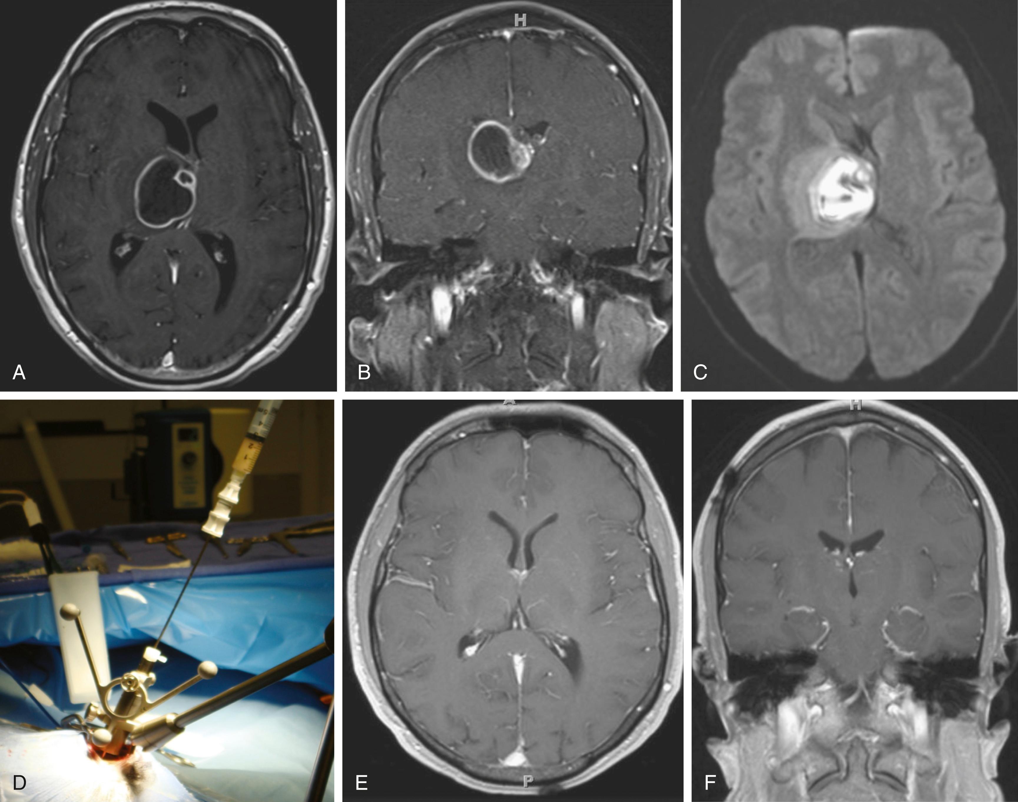 FIGURE 128.2, This 49-year-old man has a history of long-term steroids for asthma and sarcoidosis. He presented with left-sided weakness, as well as increased lethargy and confusion. Preoperative MRI axial (A) and coronal (B) T1-weighted images with contrast revealed a ring-enhancing lesion on the area of the right thalamus with mass effect and edema. (C) Diffusion-weighted signal hyperintensity in the center of the lesion suggests central necrosis, which could be compatible with an abscess. The patient was taken to the operating room. (D) A stereotactic needle biopsy with frameless surgical navigation was conducted, which revealed a pocket of purulent material. The cultures revealed a Nocardia brain abscess. The patient received 2 months of intravenous imipenem and oral trimethoprim–sulfamethoxazole. Postoperative MRI axial (E) and coronal (F) T1-weighted images with contrast showed absolute resolution of the infection.