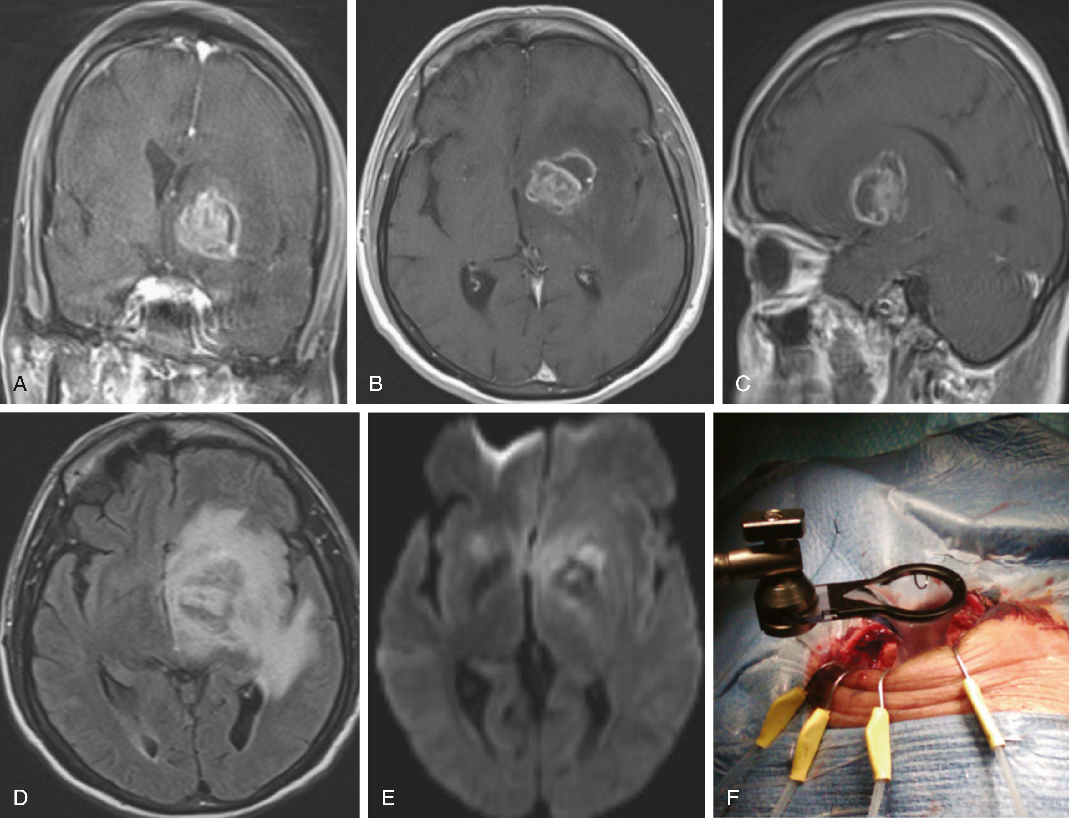 FIGURE 128.3, This 40-year-old man has a history of HIV, a CD4 count of 4, disseminating histoplasmosis, and Pneumocystis carinii pneumonia. He presented with a 2-week history of confusion and speech difficulties consistent with expressive and receptive aphasia. Preoperative MRI coronal (A), axial (B), and sagittal (C) T1-weighted images with contrast revealed an enhancing lesion on the area of the left basal ganglia with edema and mass effect. (D) An axial fluid-attenuated inversion recovery (FLAIR) image revealed mass effect and edema. (E) A diffusion-weighted signal revealed restricted diffusion within irregular areas and parts of the lesion. The patient was taken to the operating room. (F) A left-sided supraorbital craniotomy with frameless surgical navigation was conducted to approach the dominant hemispheric lesion. The cultures revealed toxoplasmic encephalitis, and the patient was treated with an 8-week course of leucovorin, pyrimethamine, and sulfadiazine.