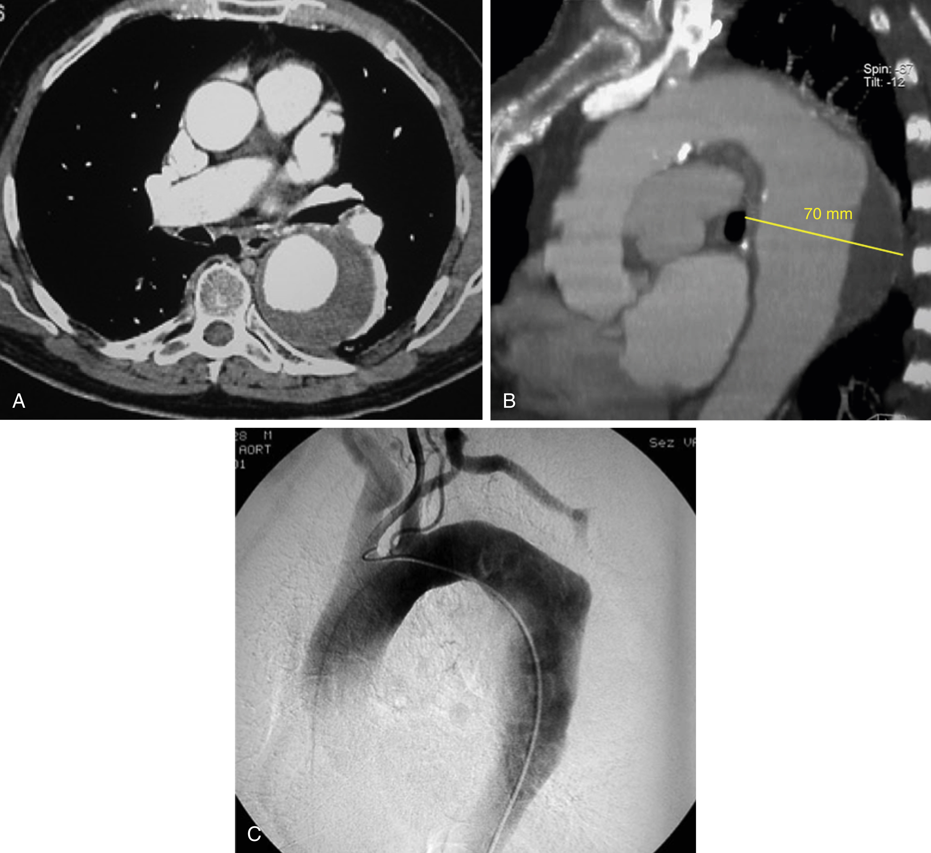 Fig. 51.1, Patient is a 72-year-old man, asymptomatic, with hypertension under medical therapy and hypercholesterolemia. (A) Computed tomography angiography showed a huge aneurysm of the descending aorta with a maximum diameter of 70 mm. Axial images showed the presence of circumferential distribution of thrombus, surrounding the aortic lumen. The thoracic aortic aneurysm (TAA) presents a regular morphology without any sign of rupture. (B) 3D multiplanar reformatted planar images in the coronal plane showed the whole extension of the TAA involving just the descending aorta. A long (>2 cm) proximal neck was evident. (C) A digital subtraction angiography was performed using a pigtail catheter, confirming the presence of the TAA along the descending aorta.