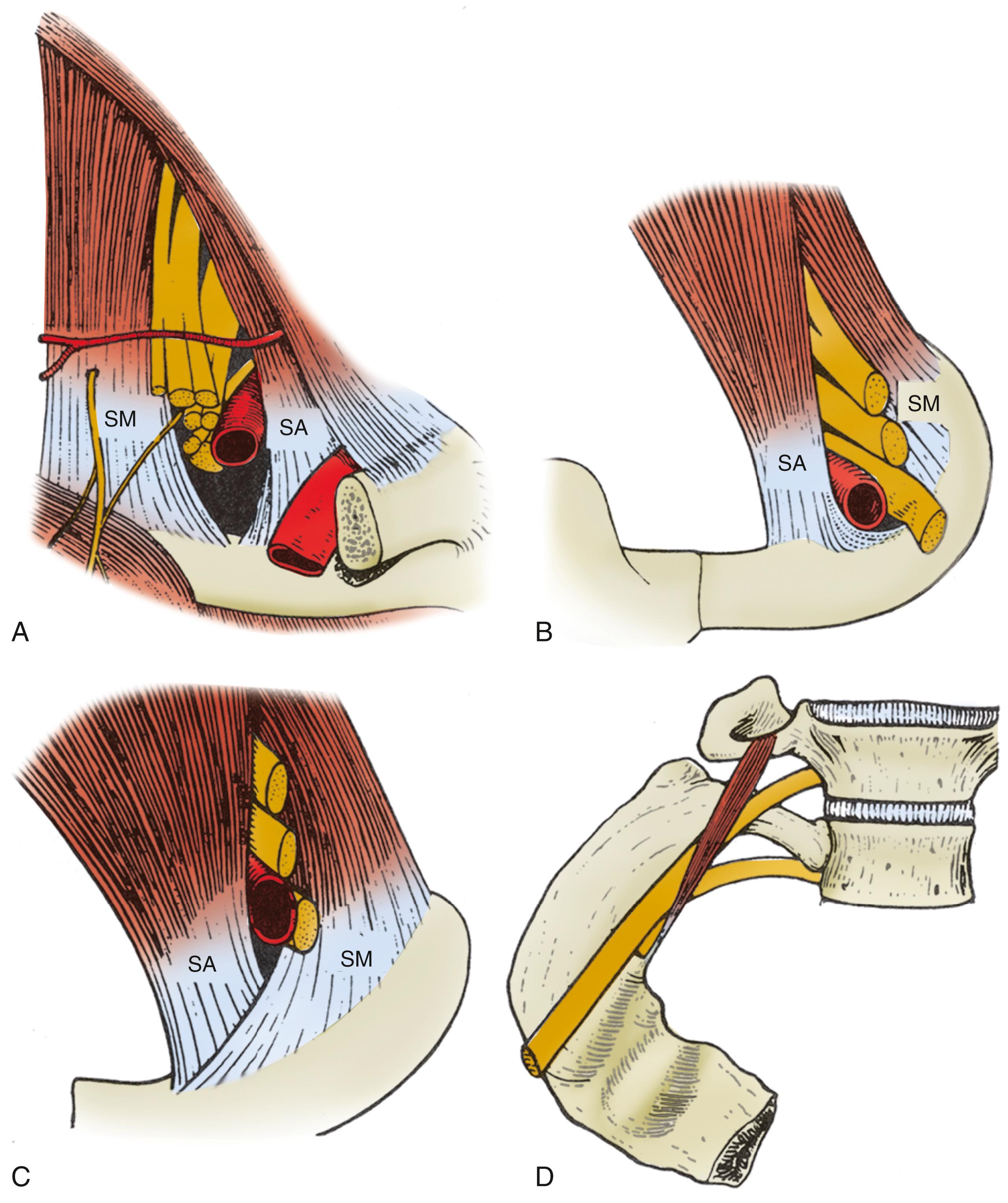 FIGURE 192.1, (A) Normal anatomy of the scalene triangle. (B) Arcuate extension of the scalene anterior extension hitching up the subclavian artery and lower trunk. (C) Overlapping insertions of the scalene muscles. (D) Scalenus minimus impinging on the first thoracic nerve root. SA , Scalenus anterior; SM , scalenus medius.