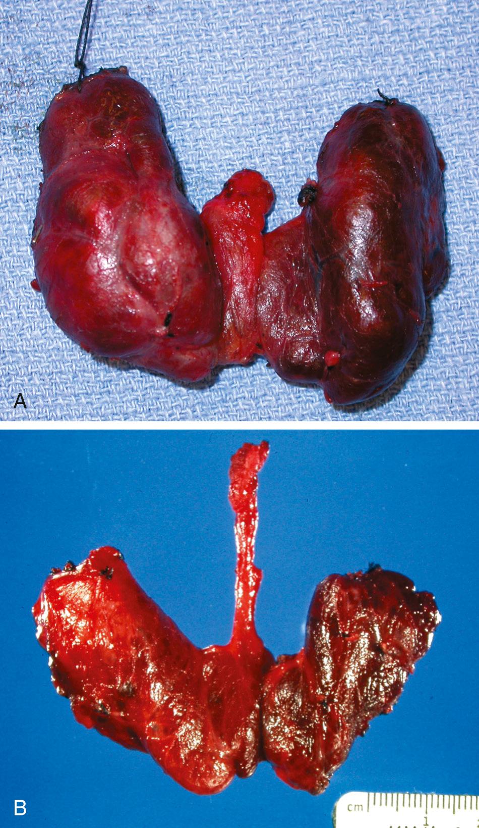 Fig. 122.2, (A and B) A pyramidal lobe of the thyroid gland may occasionally arise from the isthmus. This portion of the thyroid gland can be quite variable in size and should be carefully identified and removed with the surgical specimen.