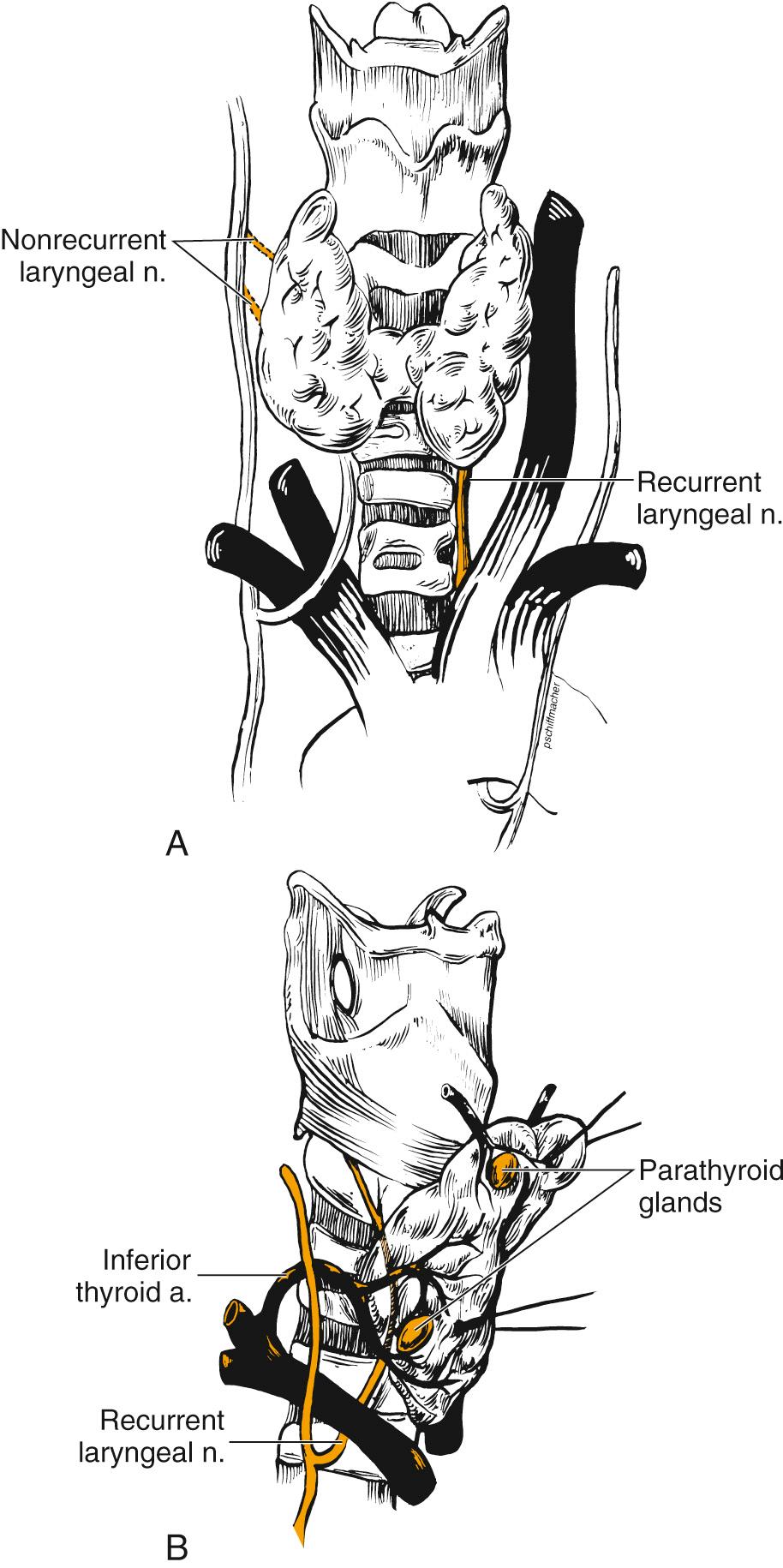 Fig. 122.3, (A and B) The thyroid gland is intimately associated with several important adjacent structures. In the lateral view, the gland has been mobilized medially to show the recurrent laryngeal nerve and its close relationship to the inferior thyroid artery. This relationship can vary between sides within a patient. The potential courses of the nonrecurrent laryngeal nerve are indicated (dashed lines) .