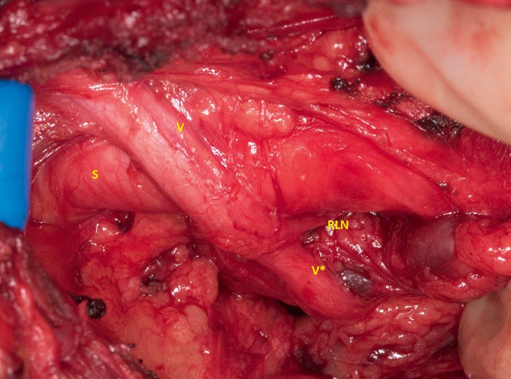 Fig. 122.4, The right vagus nerve (V) can be seen traveling over the subclavian artery (S) . The distal vagus nerve (V*) continues to travel inferiorly, while the recurrent laryngeal nerve (RLN) turns superiorly and travels deep to the subclavian artery.