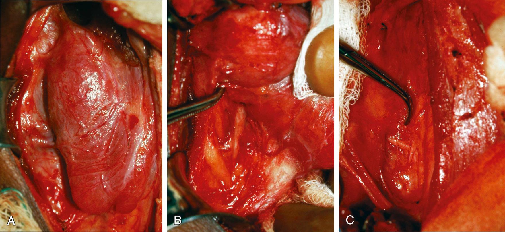 Fig. 122.5, (A) Careful dissection along the lateral portion of the thyroid lobe permits mobilization of the gland medially. The middle thyroid vein(s) should be carefully identified and ligated. (B) The course of the recurrent laryngeal nerve along the tracheoesophageal groove is shown intraoperatively. (C) The lateral course of a nonrecurrent laryngeal nerve has been revealed intraoperatively.