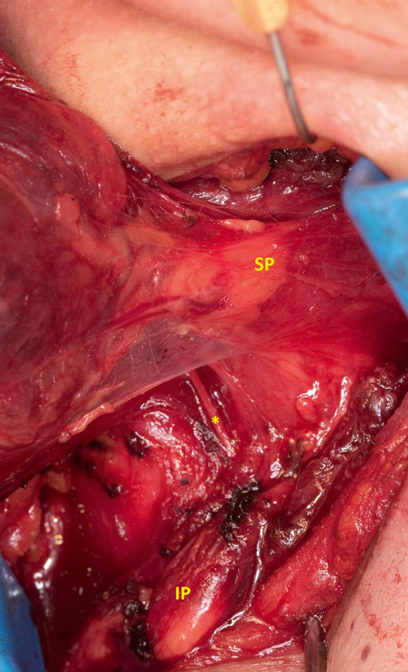 Fig. 122.8, Intraoperative view of the superior parathyroid gland (SP) , inferior parathyroid gland (IP) , and their relation to the recurrent laryngeal nerve (*) which is traveling in the tracheoesophageal groove.