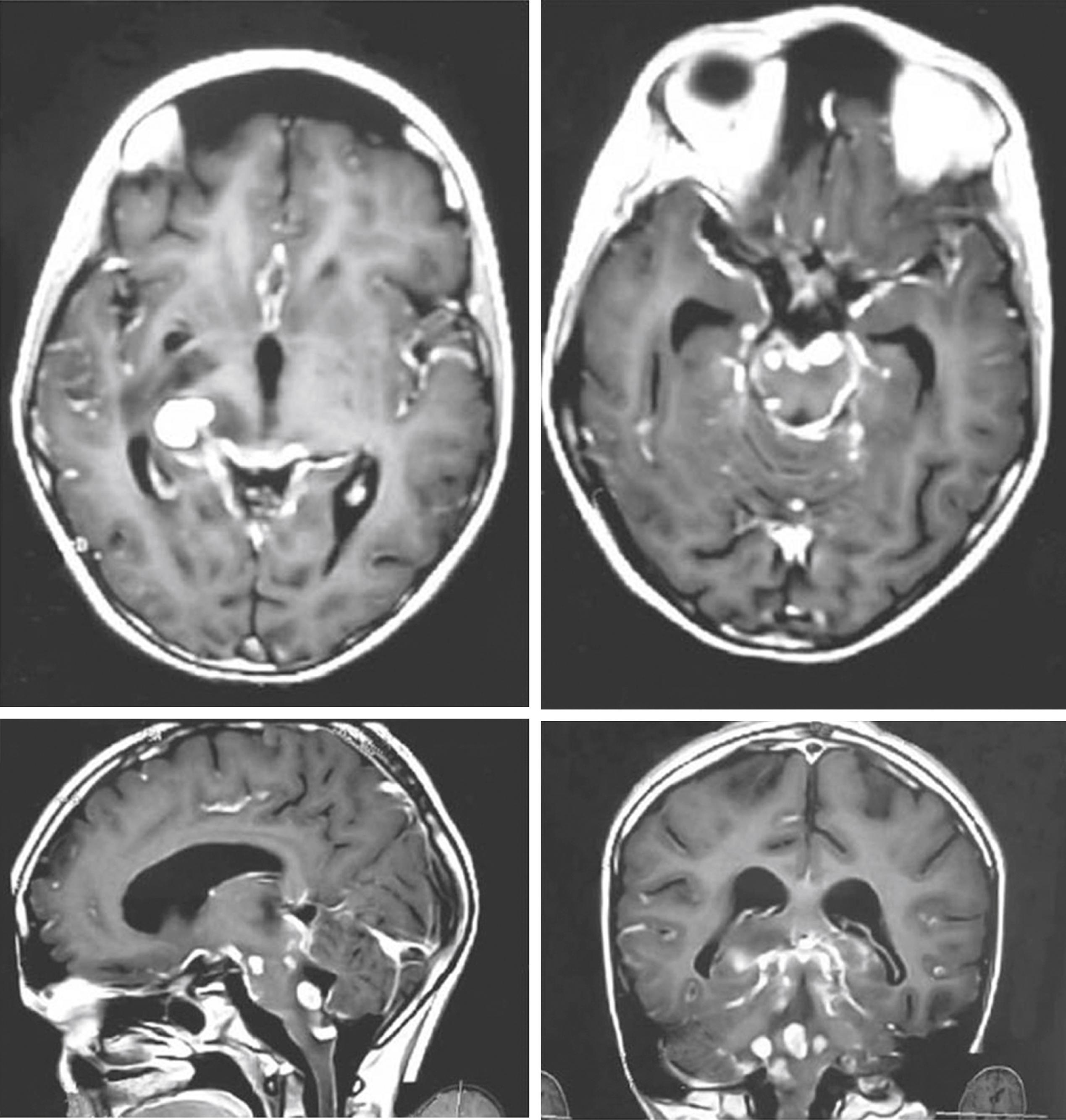 FIGURE 132.3, Gadolinium–diethylene triamine penta-acetic acid–enhanced T1-weighted axial, sagittal, and coronal images demonstrate enhancement of the leptomeninges over the surface of the brain. There are also multiple tubercles studding the brain parenchyma.