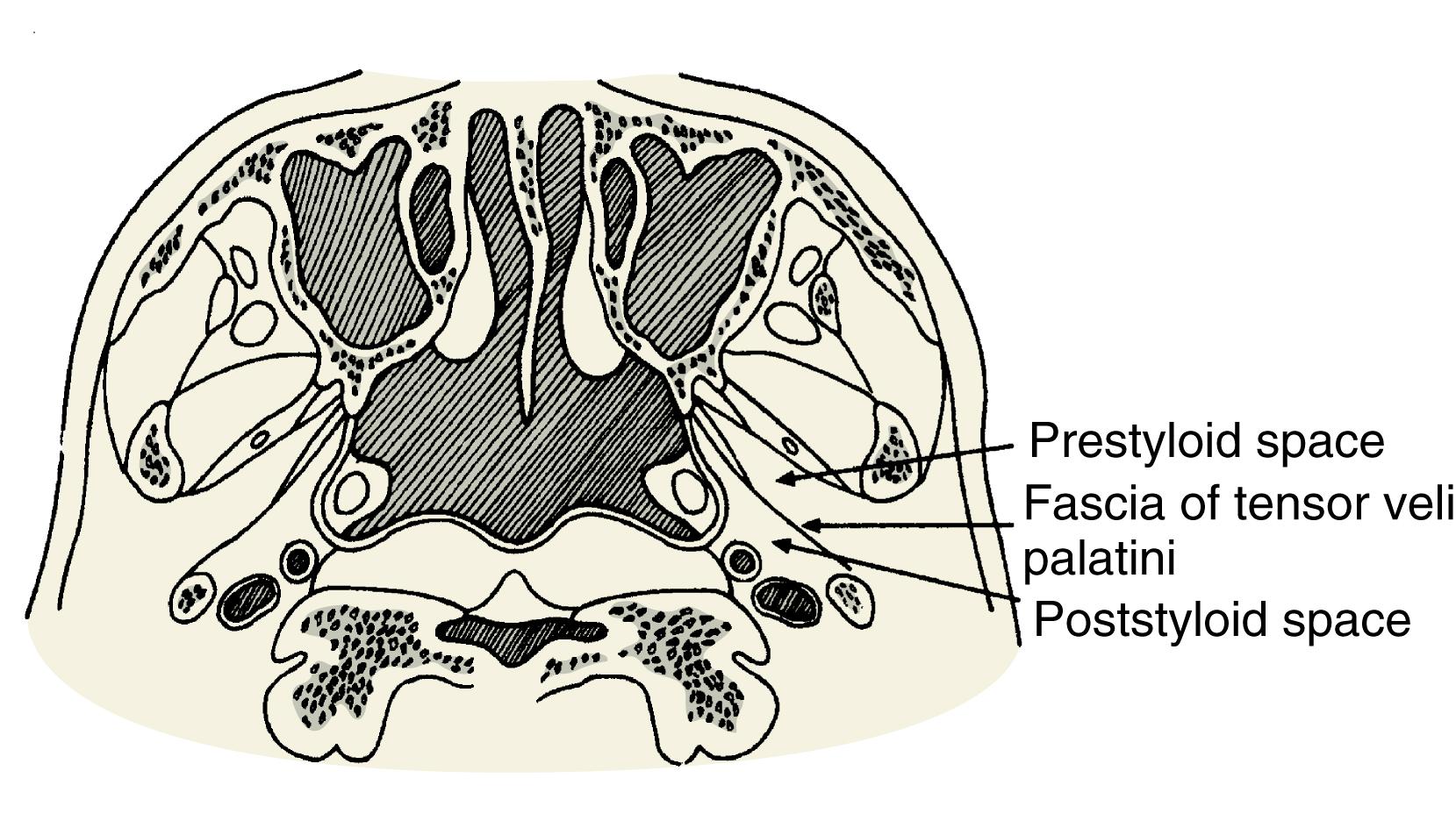 Fig. 69.2, The fascia of the tensor veli palatini muscle divides the parapharyngeal space into a prestyloid and a poststyloid compartment.