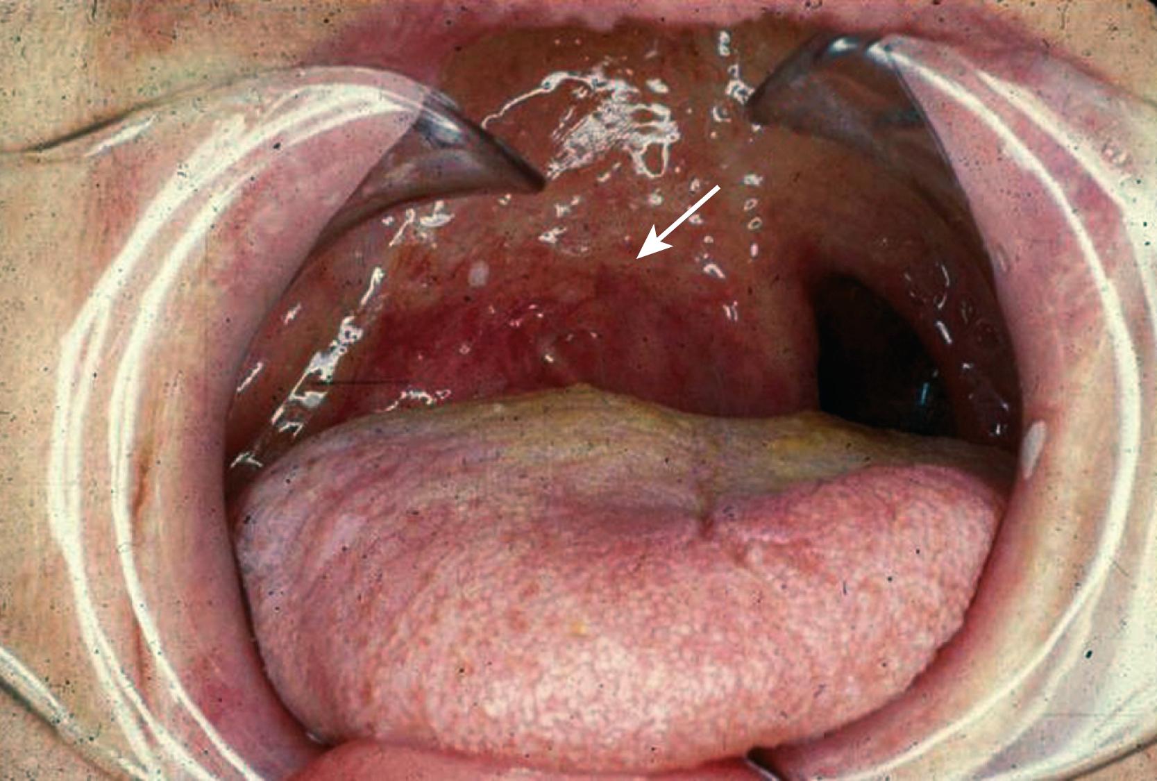 Fig. 69.3, Typical appearance of a tumor of the parapharyngeal space displacing tonsil and uvula medially (arrow).