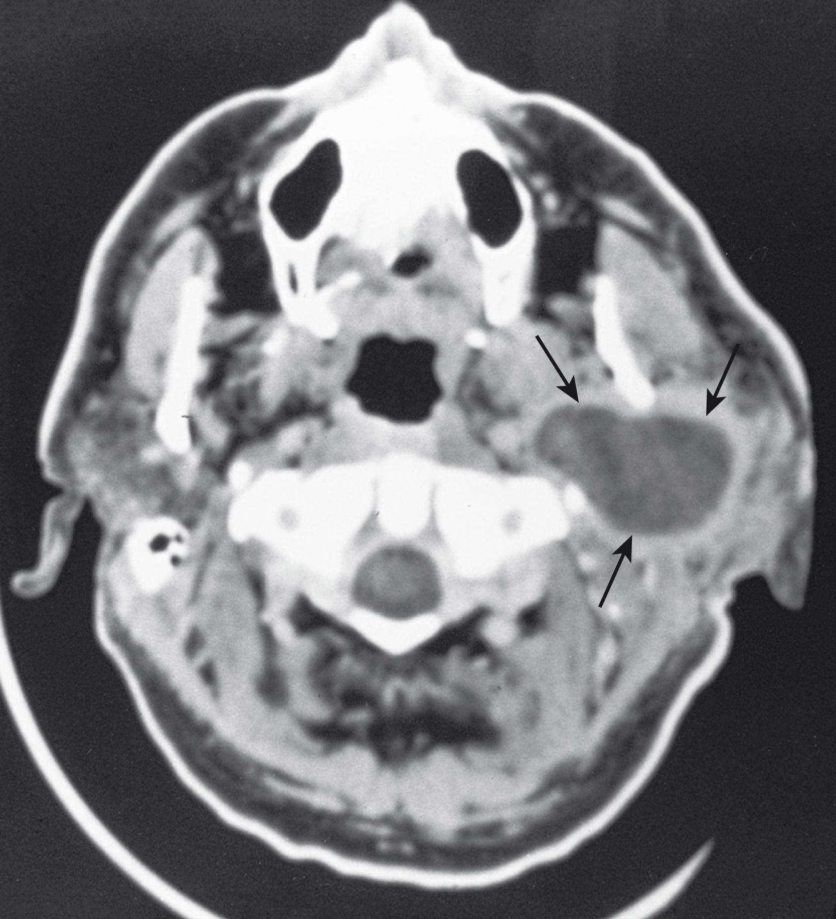 Fig. 69.4, Axial computed tomography scan of a pleomorphic adenoma originating in the deep lobe of the parotid gland with extension through the stylomandibular tunnel into the prestyloid parapharyngeal space (arrows) .